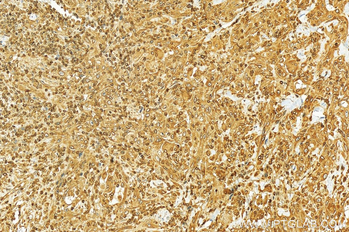 IHC staining of human skin cancer using 12398-1-AP