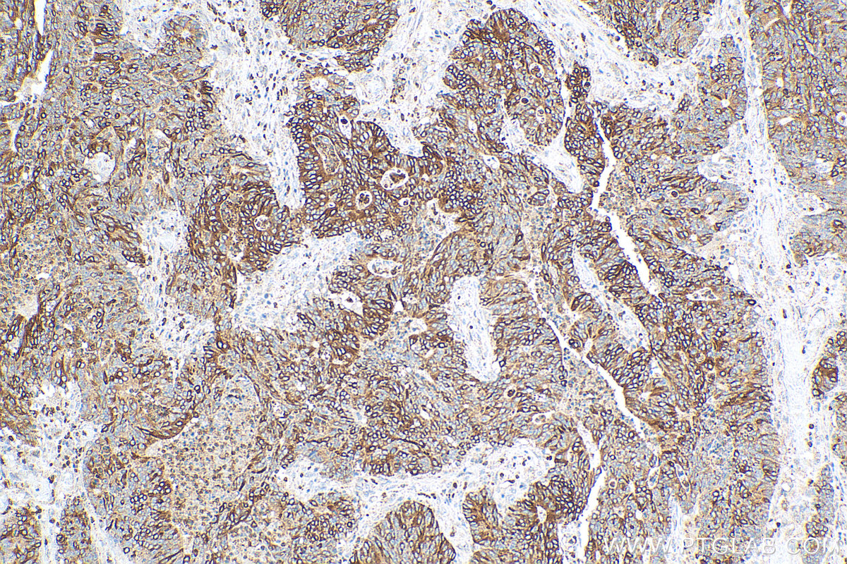 IHC staining of human colon cancer using 26991-1-AP