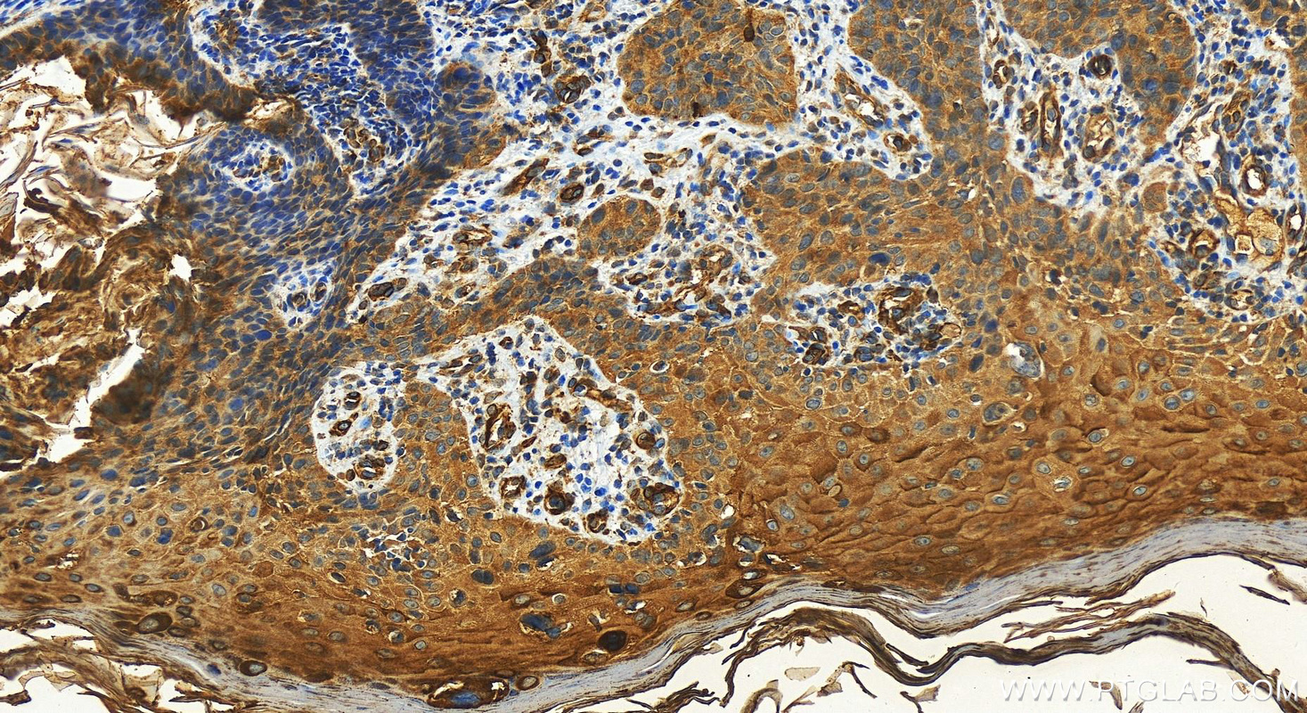 IHC staining of Human bowens disease using 30700-1-AP