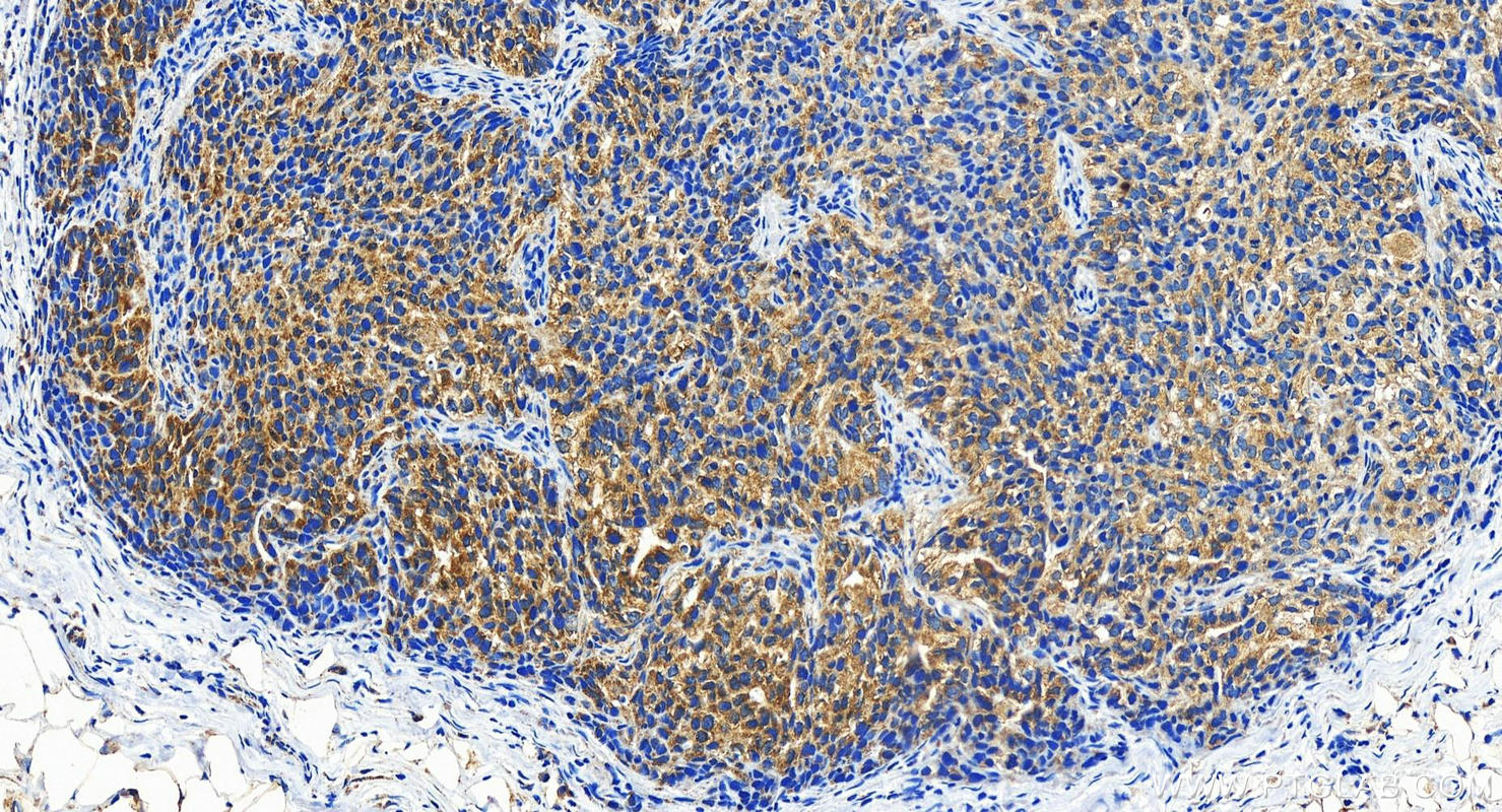 IHC staining of human ovary cancer using 19988-1-AP