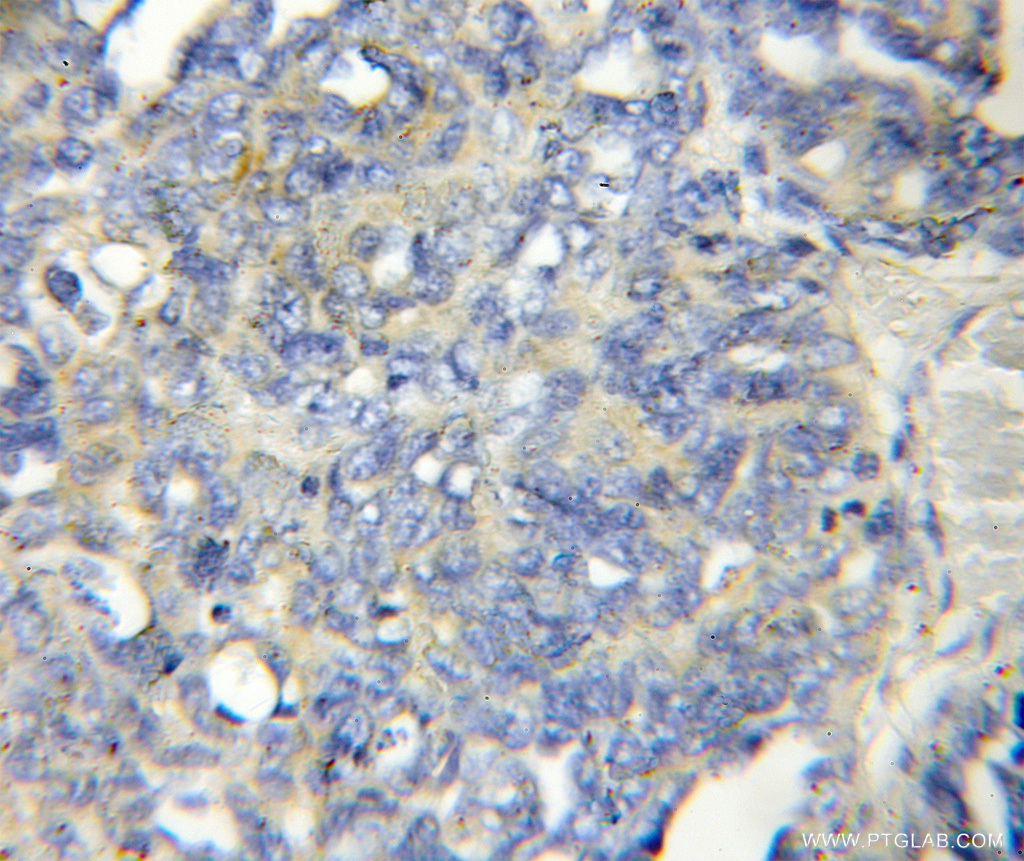 IHC staining of human ovary tumor using 11406-1-AP