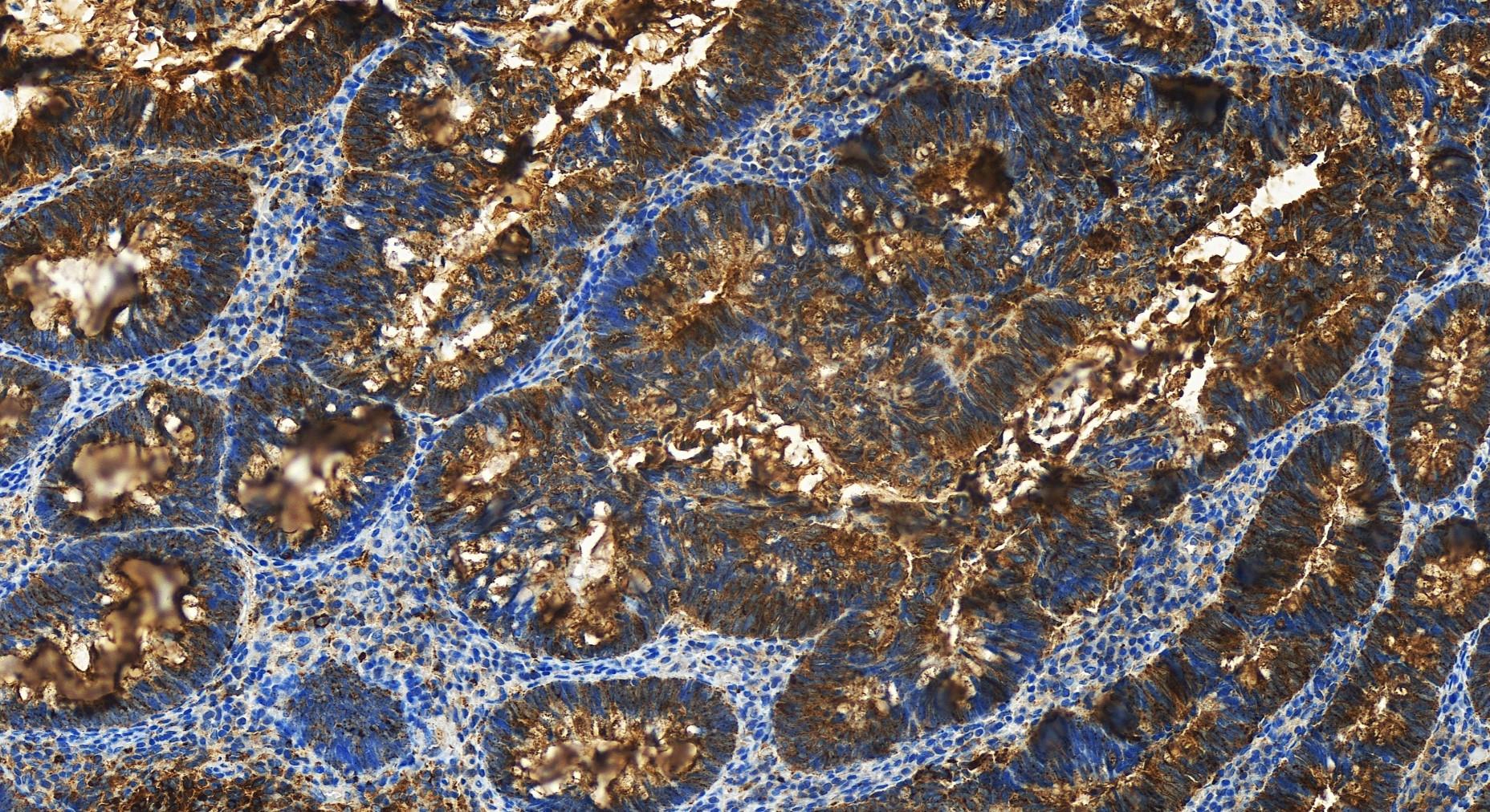 IHC staining of human colon  cancer using 10281-1-AP