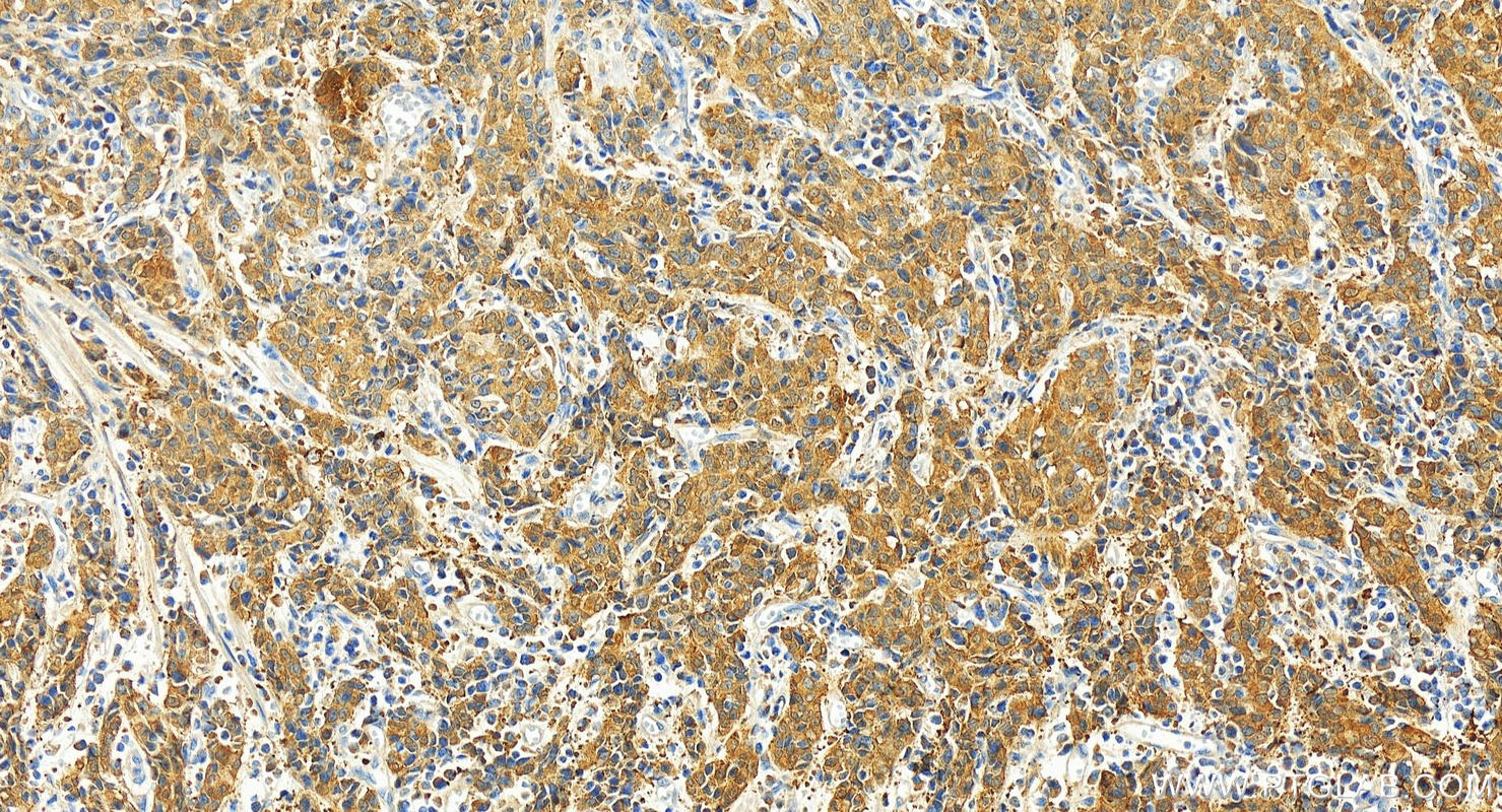 IHC staining of human stomach cancer using 27552-1-AP