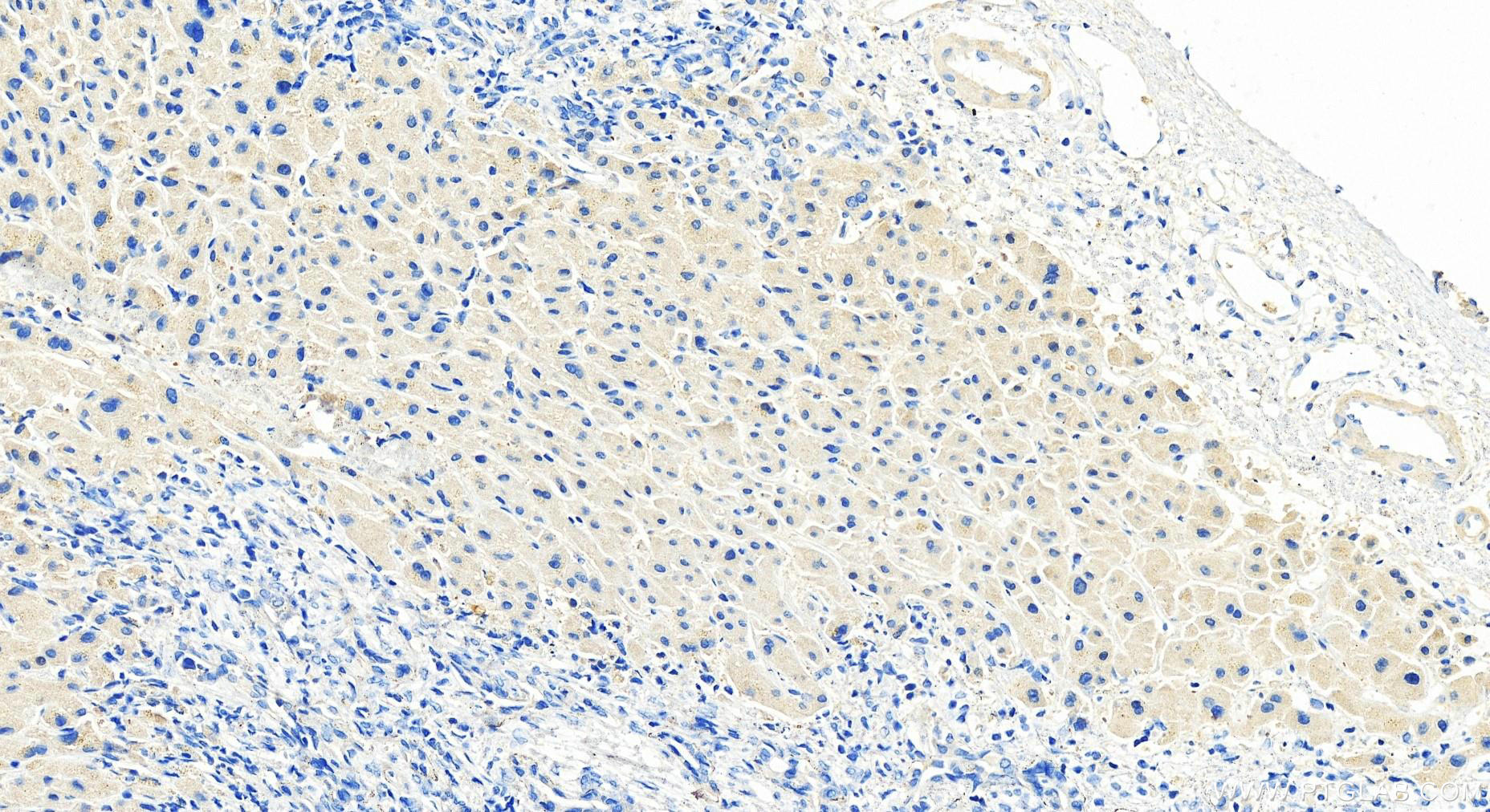 IHC staining of human intrahepatic cholangiocarcinoma using 10955-1-AP