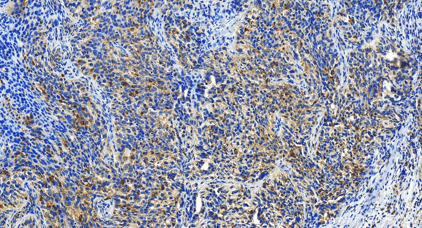 IHC staining of human ovary cancer using 17938-1-AP