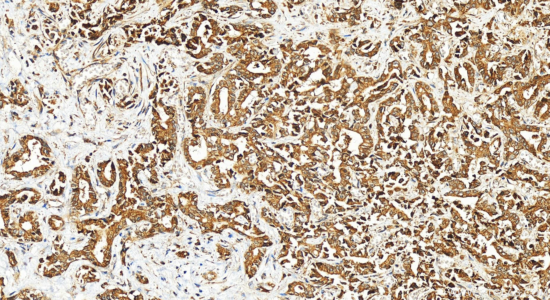 IHC staining of human intrahepatic cholangiocarcinoma using 12840-1-AP