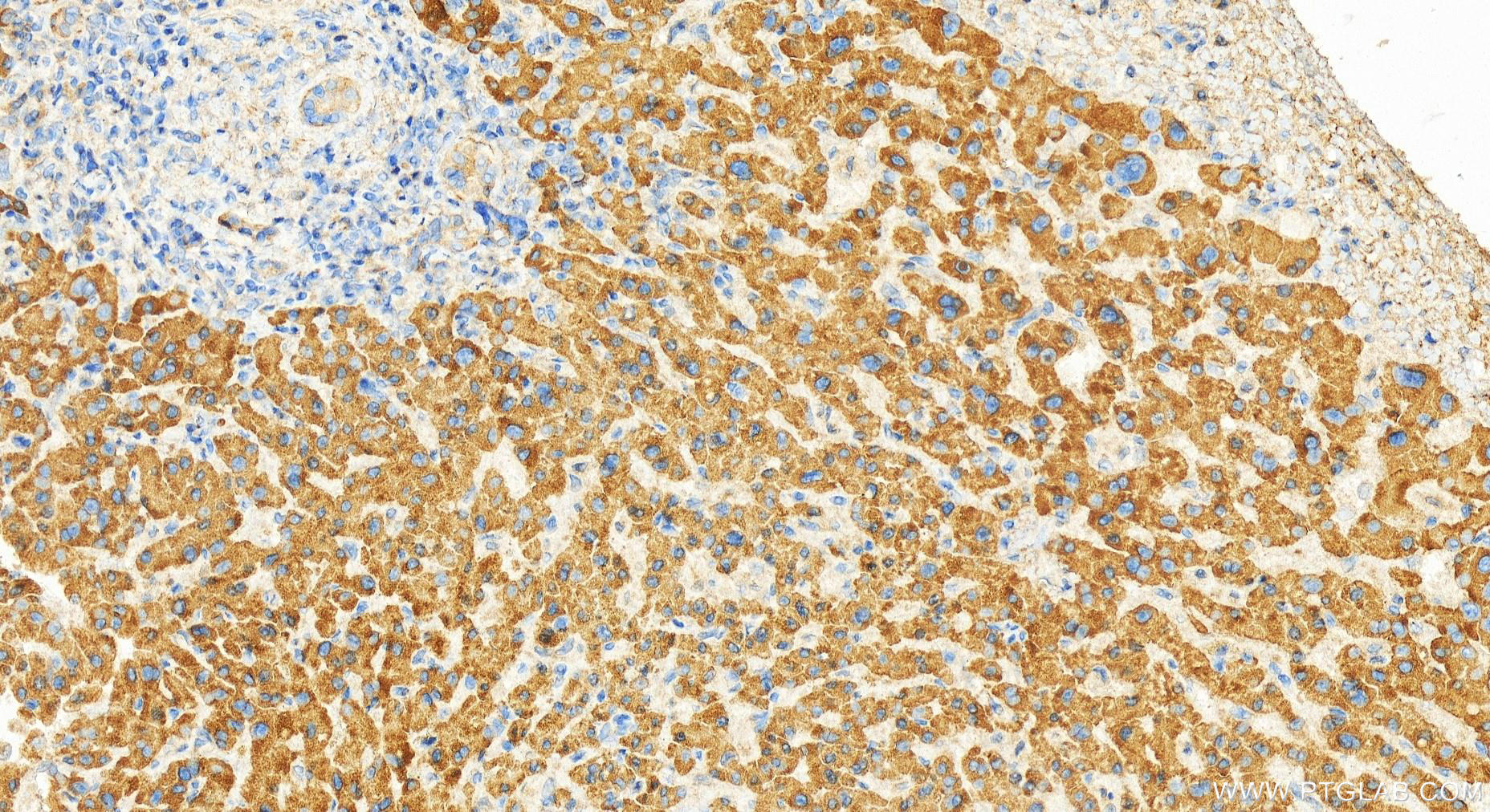 IHC staining of human intrahepatic cholangiocarcinoma using 12840-1-AP