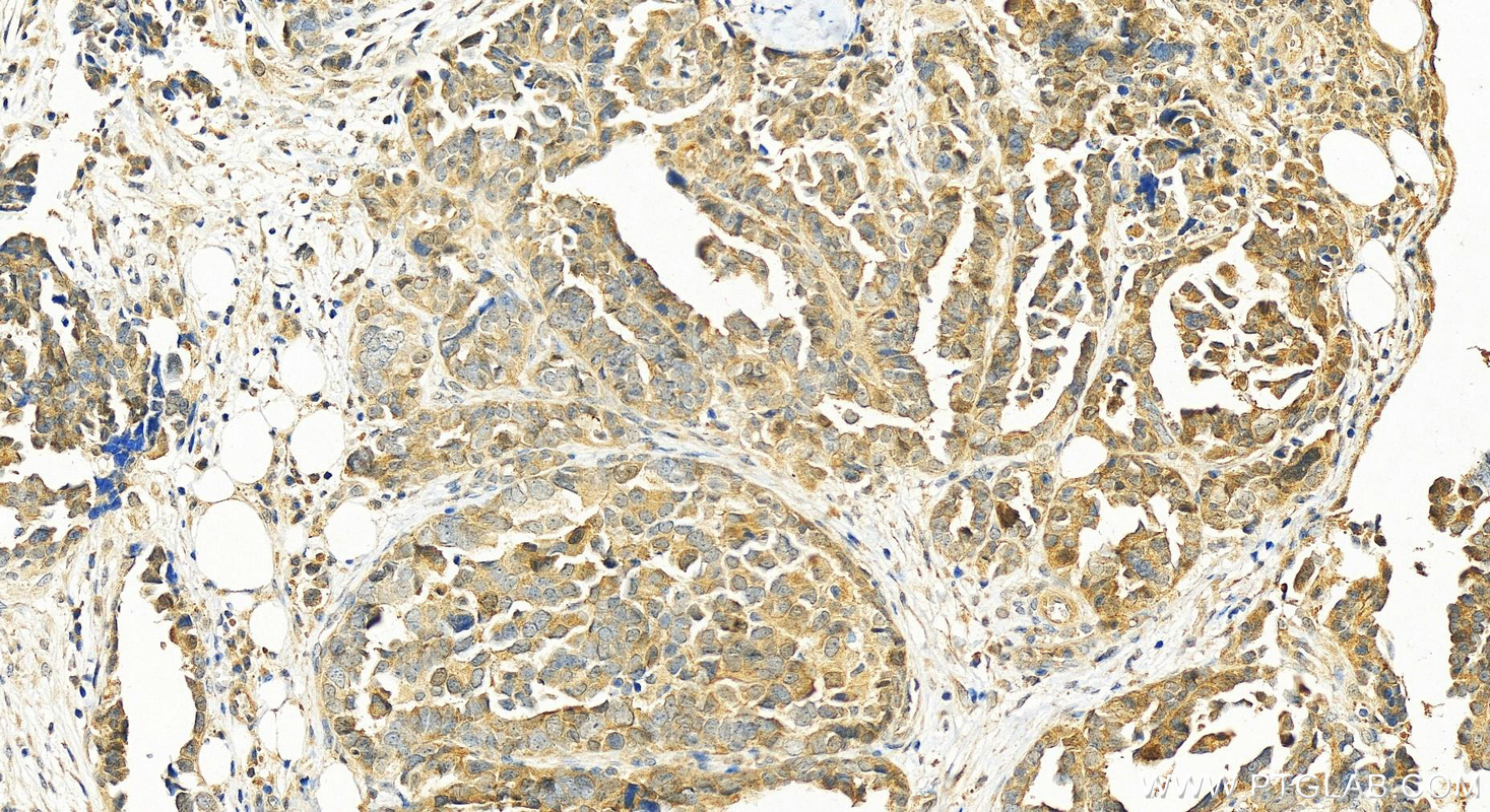 IHC staining of human ovary cancer using 26424-1-AP