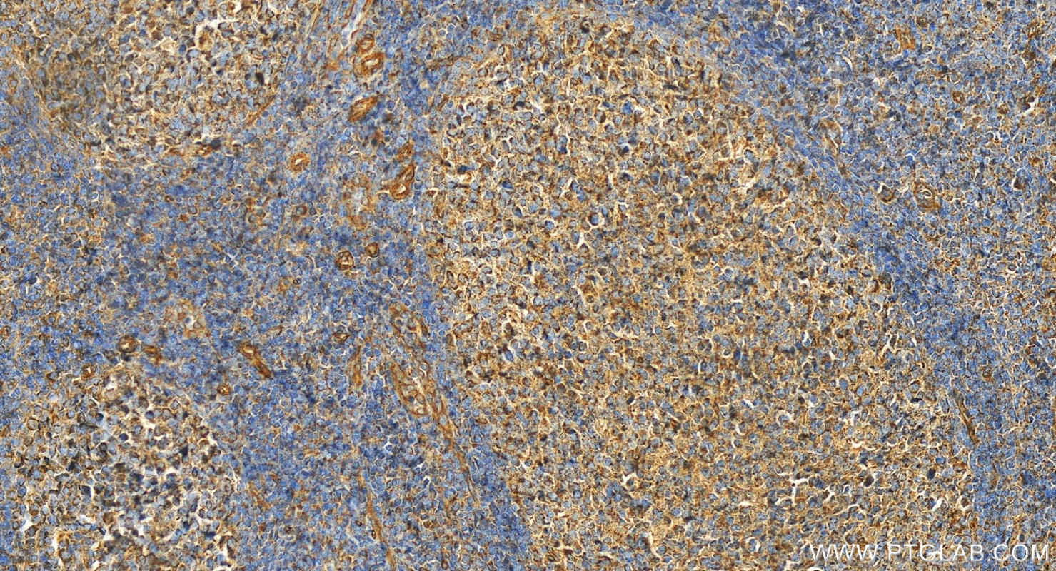 IHC staining of human tonsillitis using 11461-1-AP