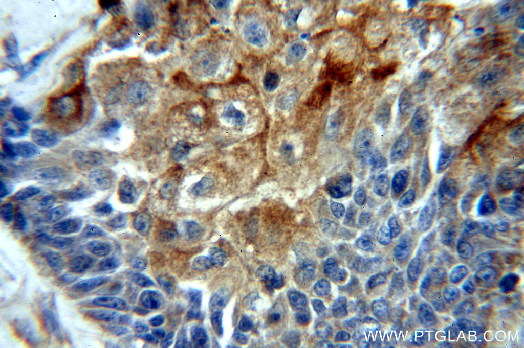 IHC staining of human oesophagus cancer using 20772-1-AP