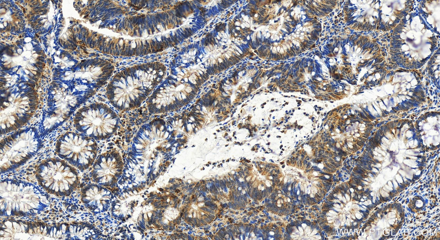 IHC staining of human colon cancer using 12956-1-AP