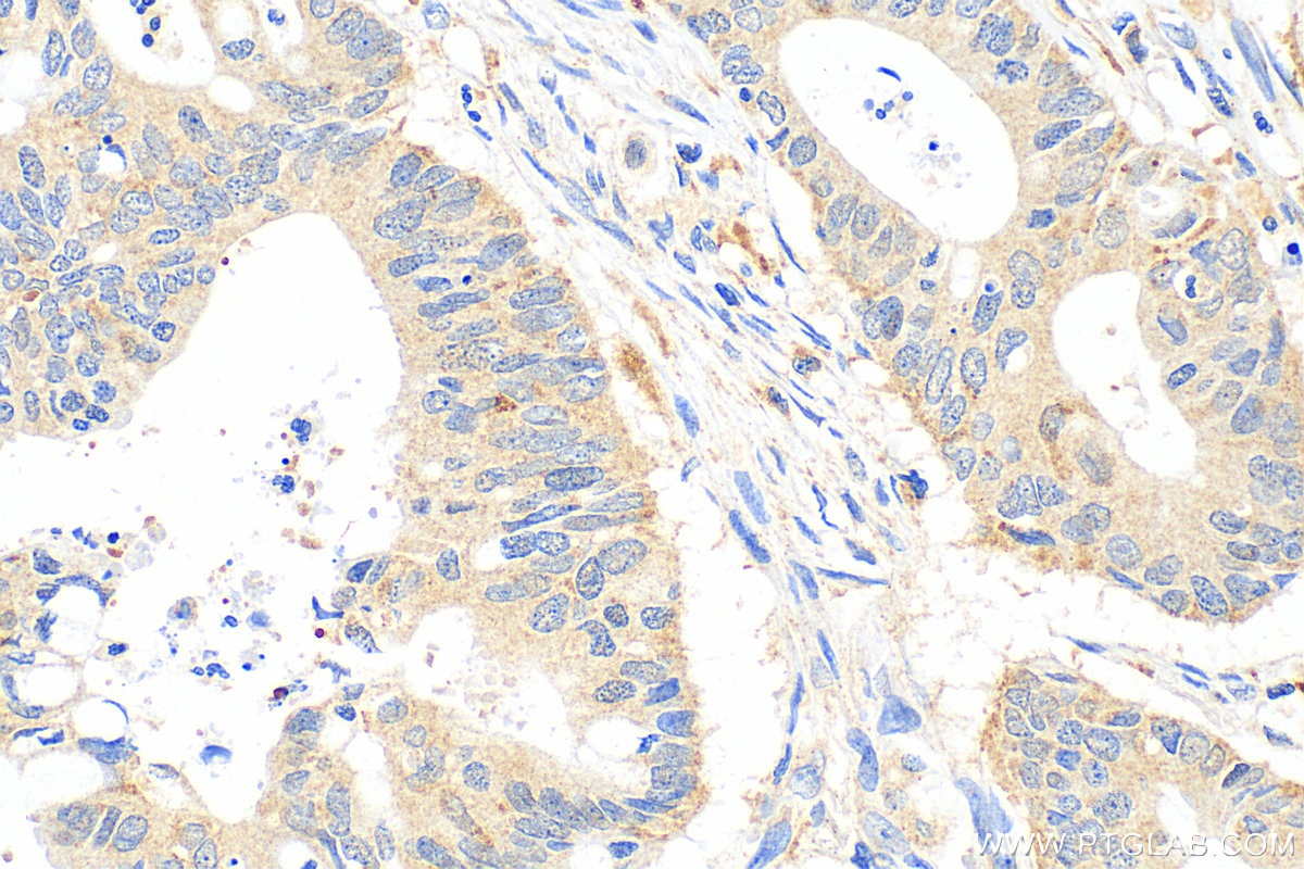 IHC staining of human colon cancer using 12956-1-AP