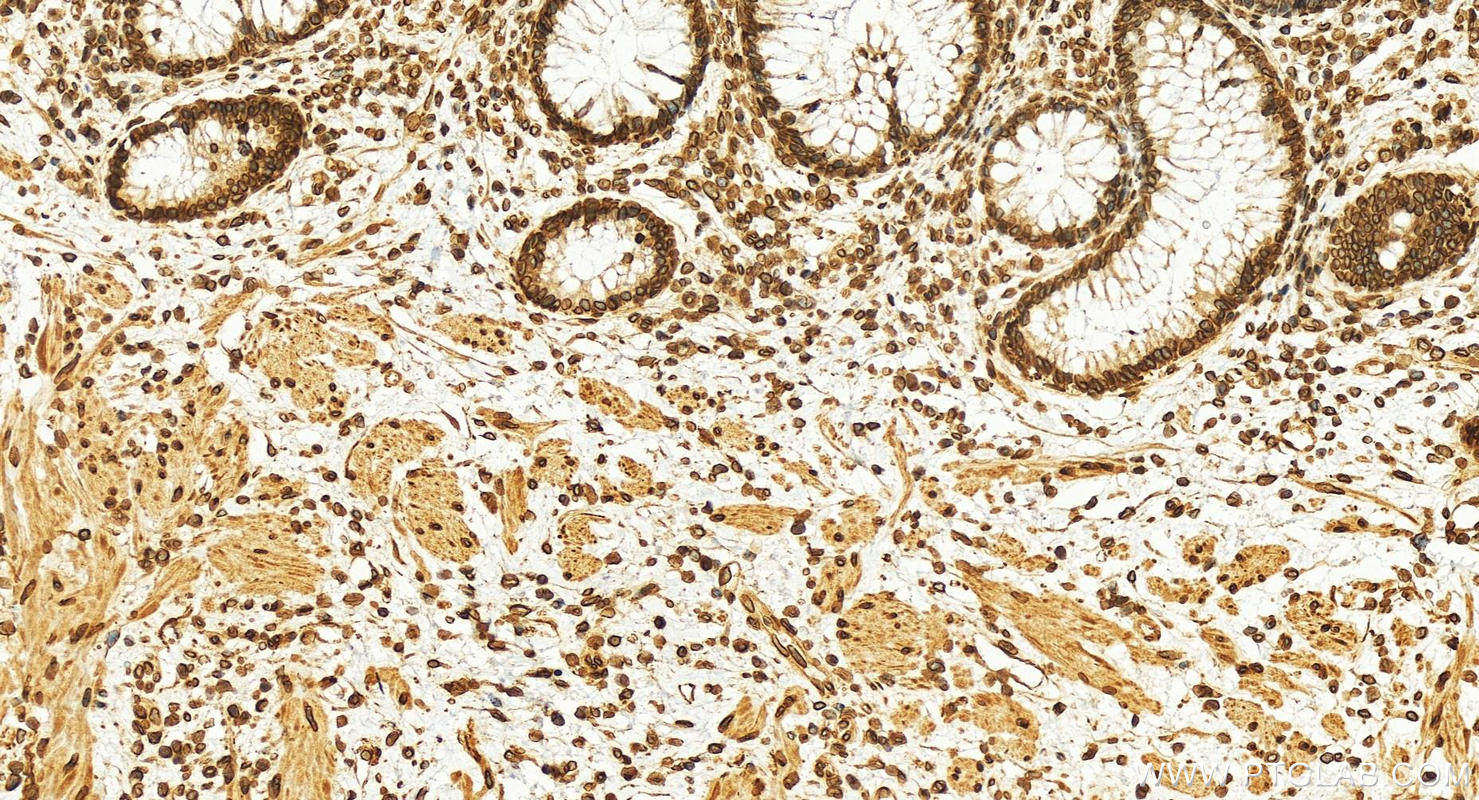 IHC staining of human colon cancer using 10895-1-AP