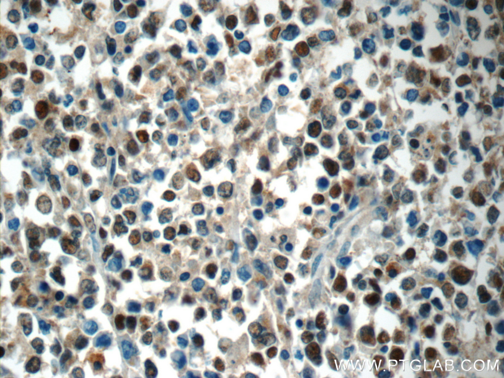 IHC staining of human lymphoma using 10931-1-AP