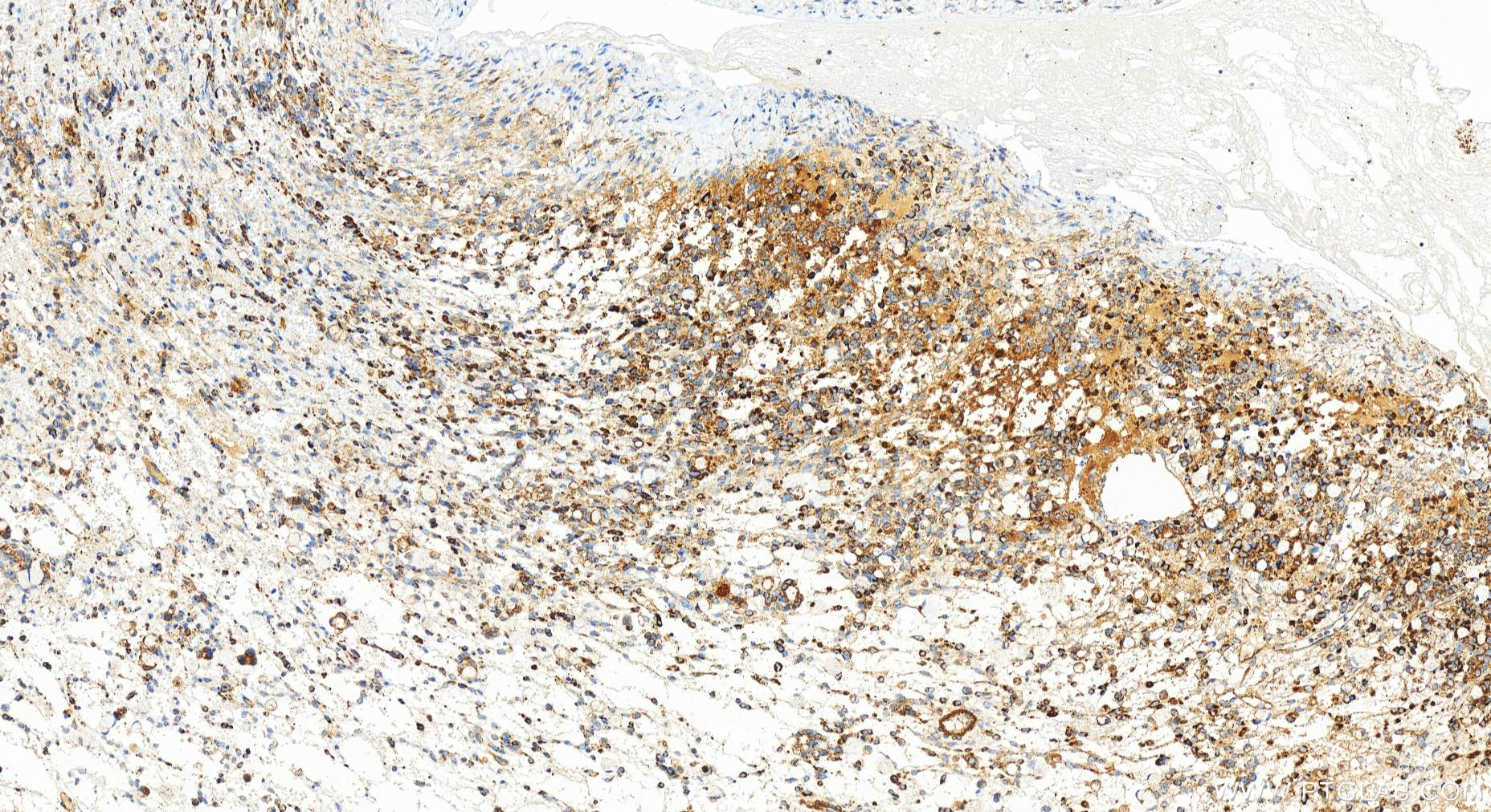 IHC staining of human ovary cancer using 83552-2-RR (same clone as 83552-2-PBS)