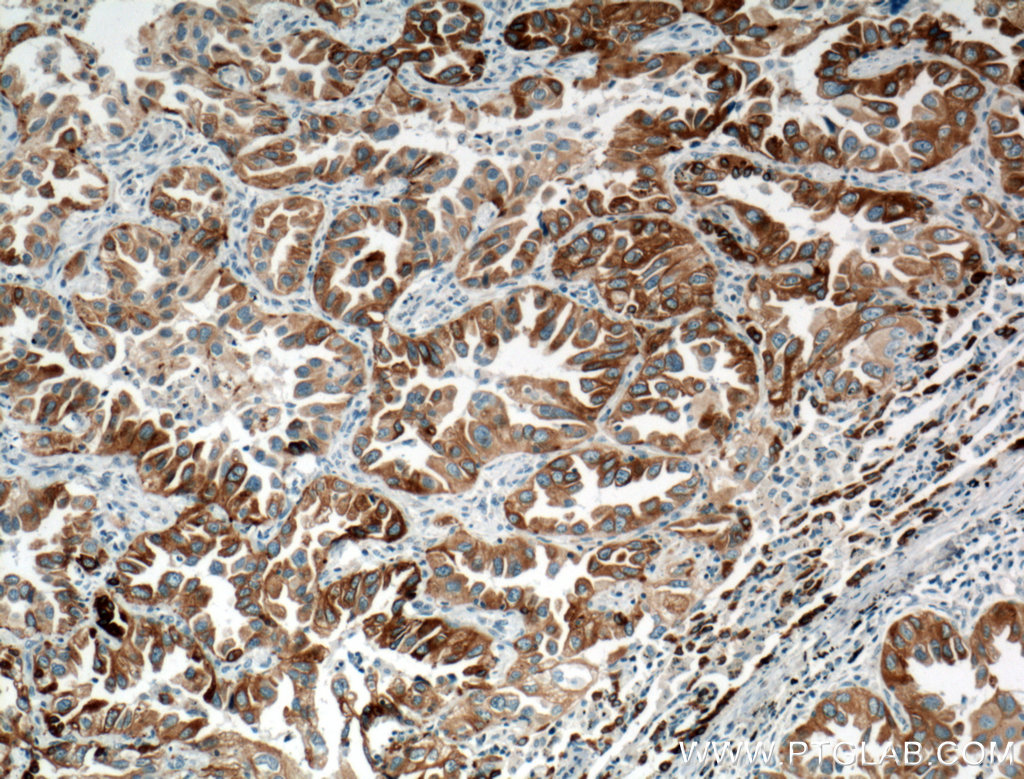 IHC staining of human lung cancer using 66044-1-Ig (same clone as 66044-1-PBS)