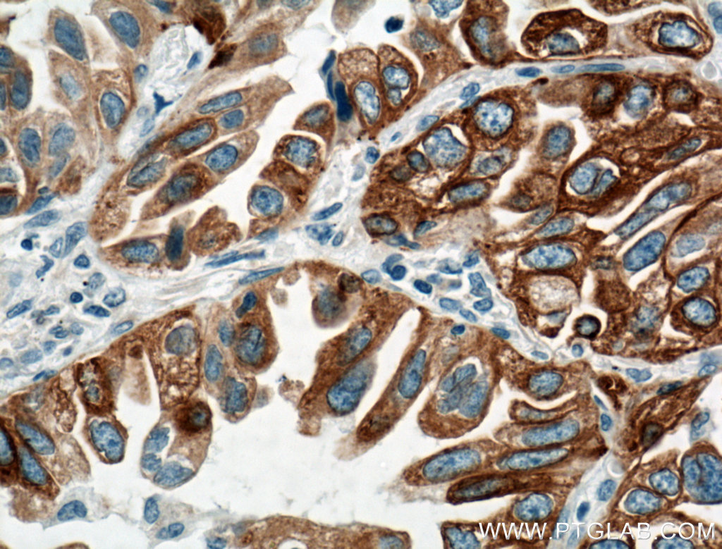 IHC staining of human lung cancer using 66044-1-Ig (same clone as 66044-1-PBS)