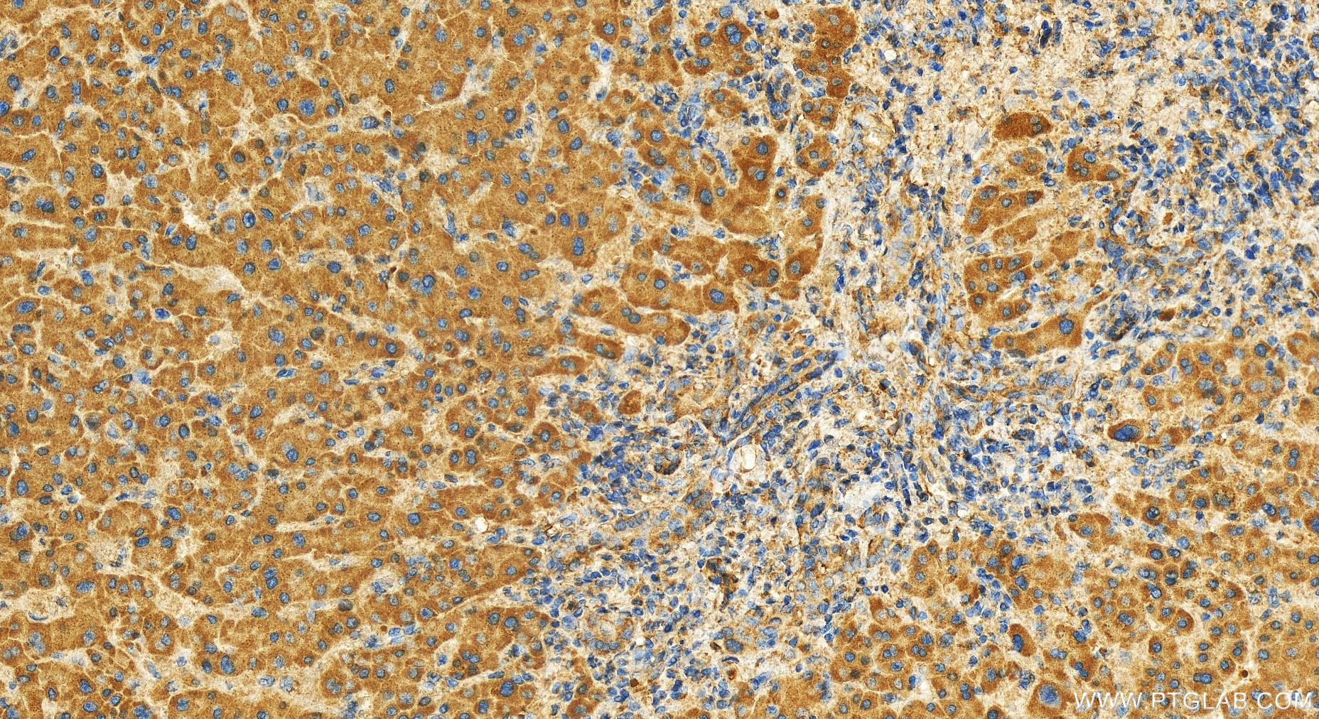 IHC staining of human intrahepatic cholangiocarcinoma using 17905-1-AP