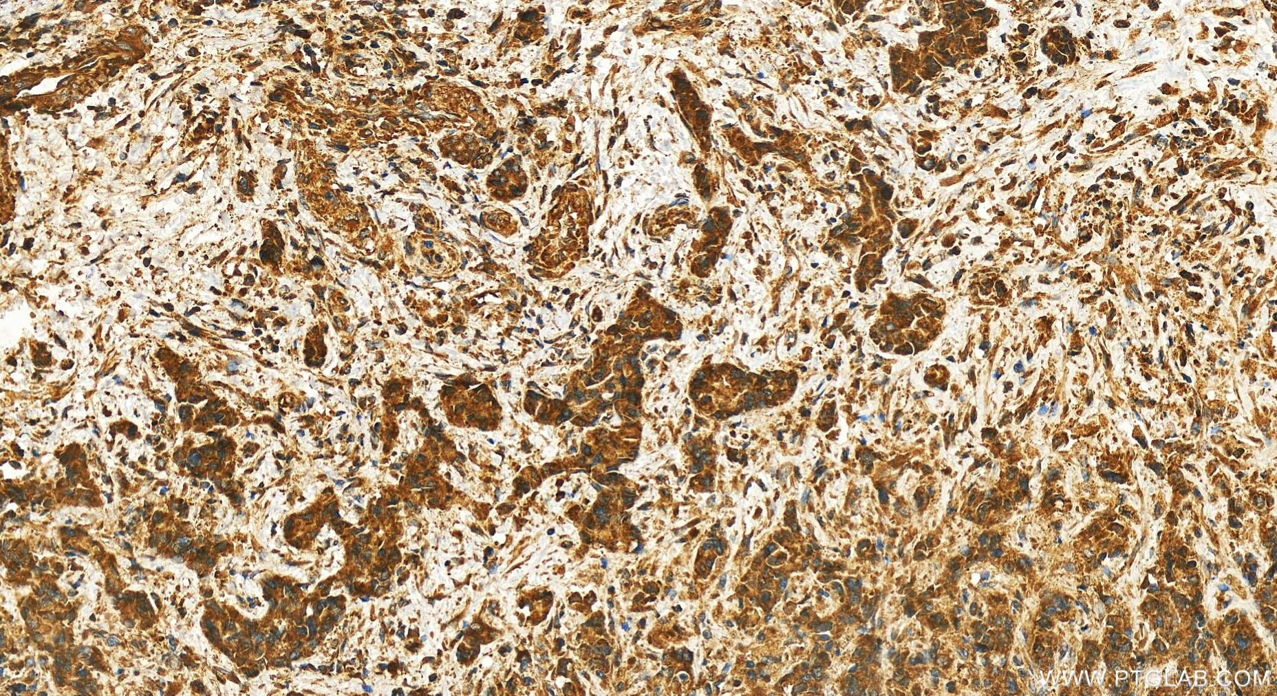 IHC staining of human intrahepatic cholangiocarcinoma using 17905-1-AP