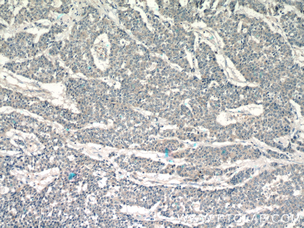 IHC staining of human colon cancer using 10376-1-AP