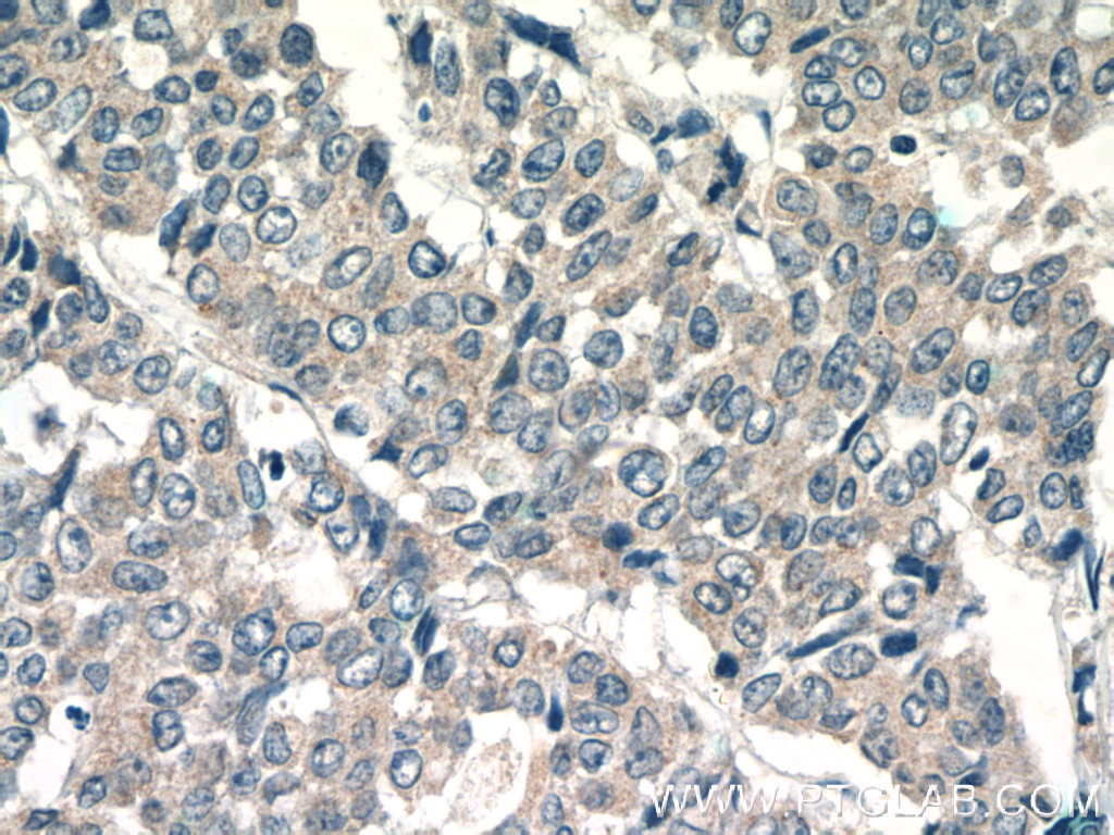 IHC staining of human colon cancer using 10376-1-AP