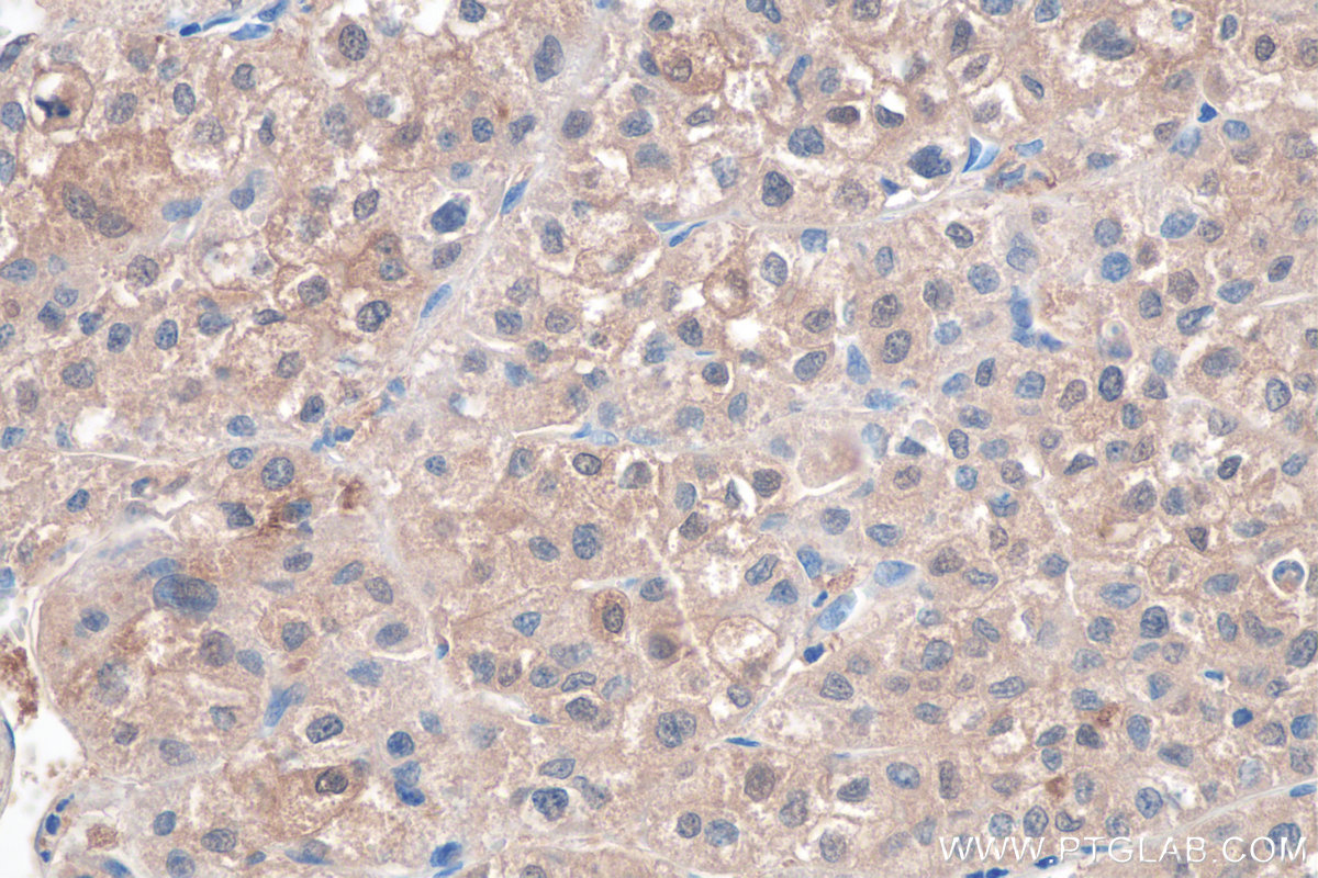 IHC staining of human liver cancer using 25732-1-AP