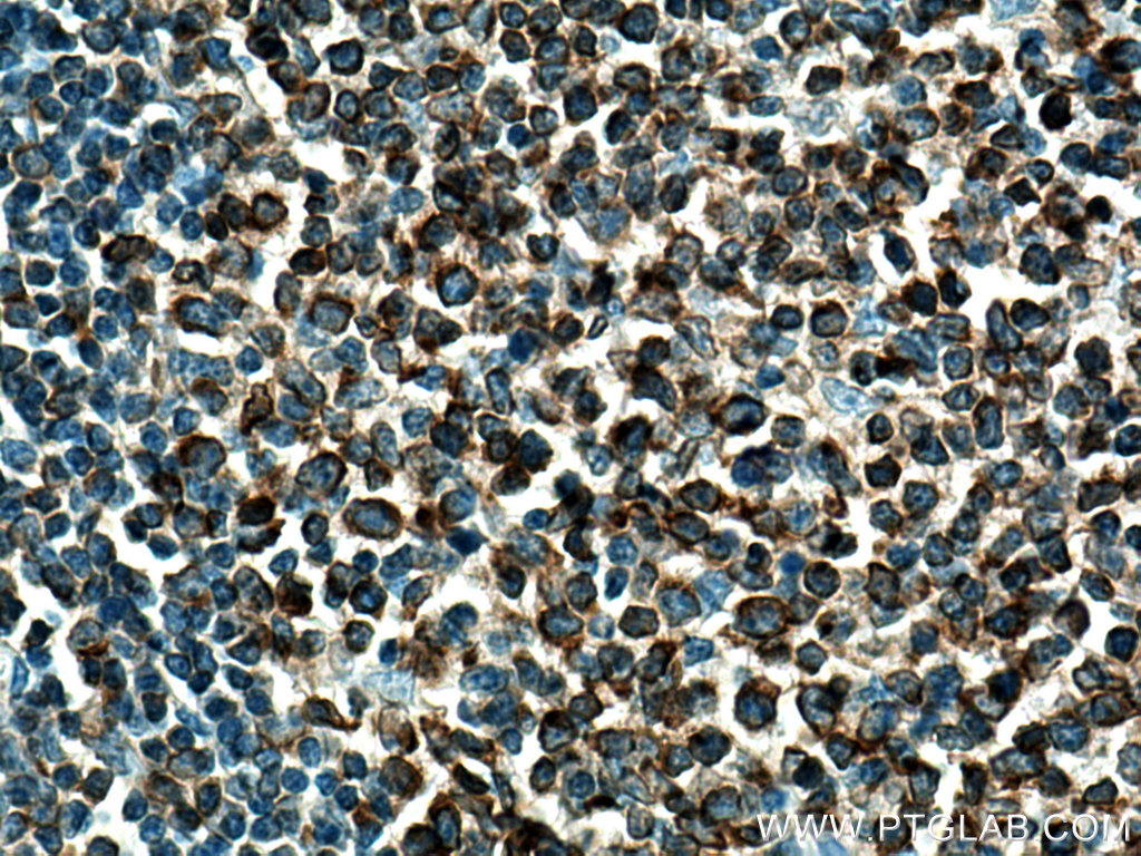 IHC staining of human tonsillitis using 24772-1-AP