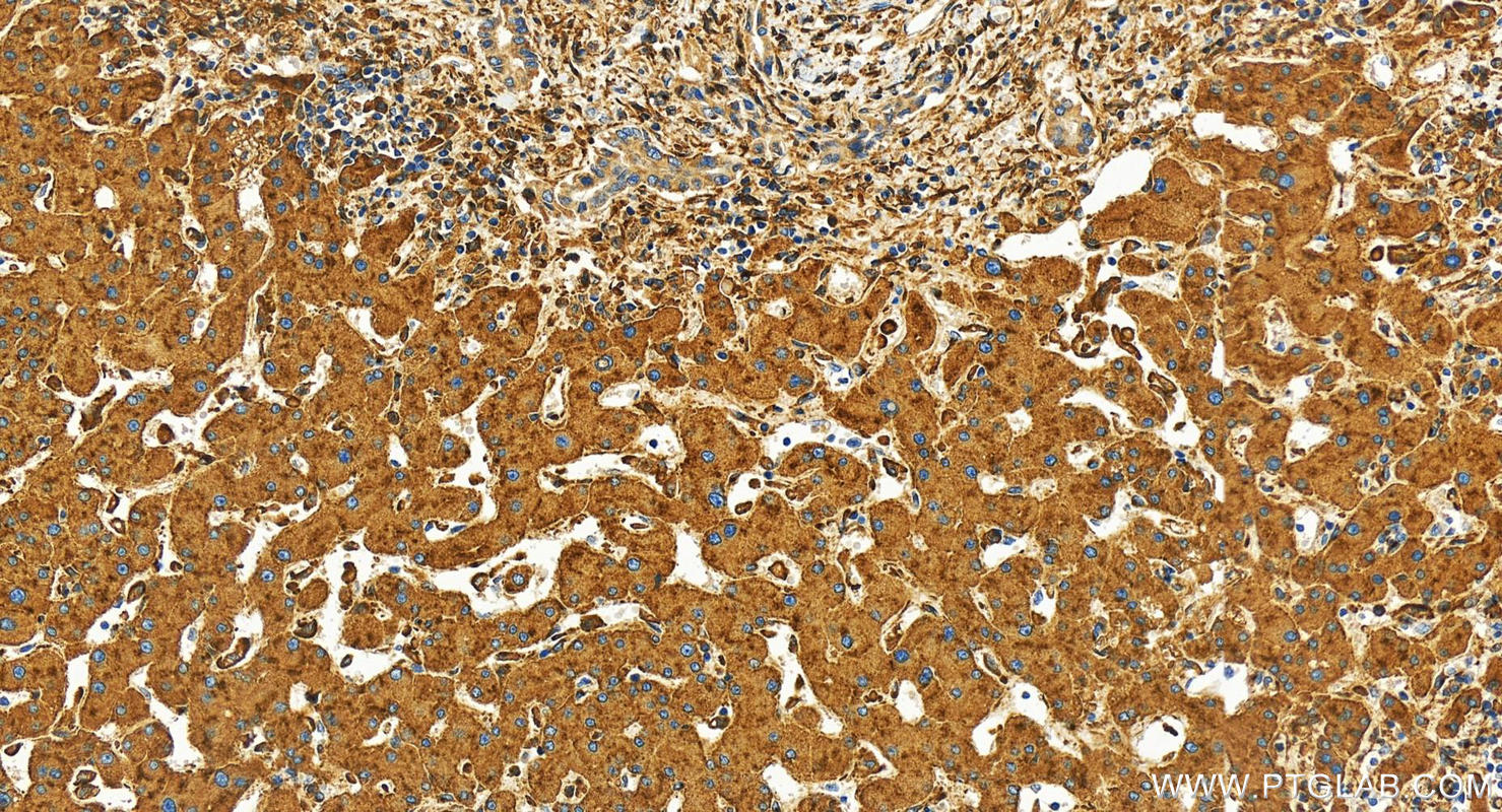 IHC staining of human intrahepatic cholangiocarcinoma using 30206-1-AP