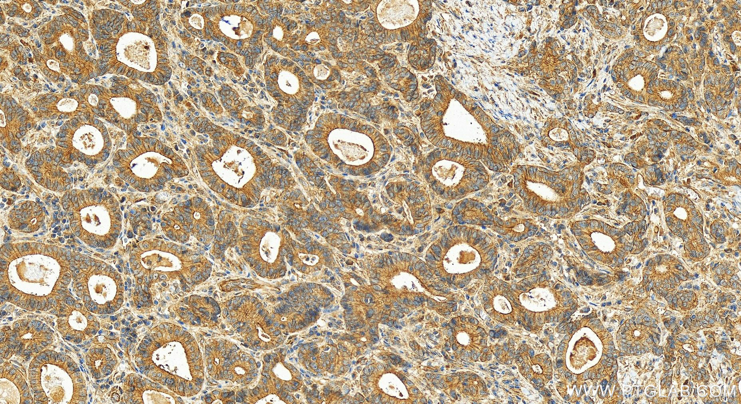 IHC staining of human stomach cancer using 10128-2-AP