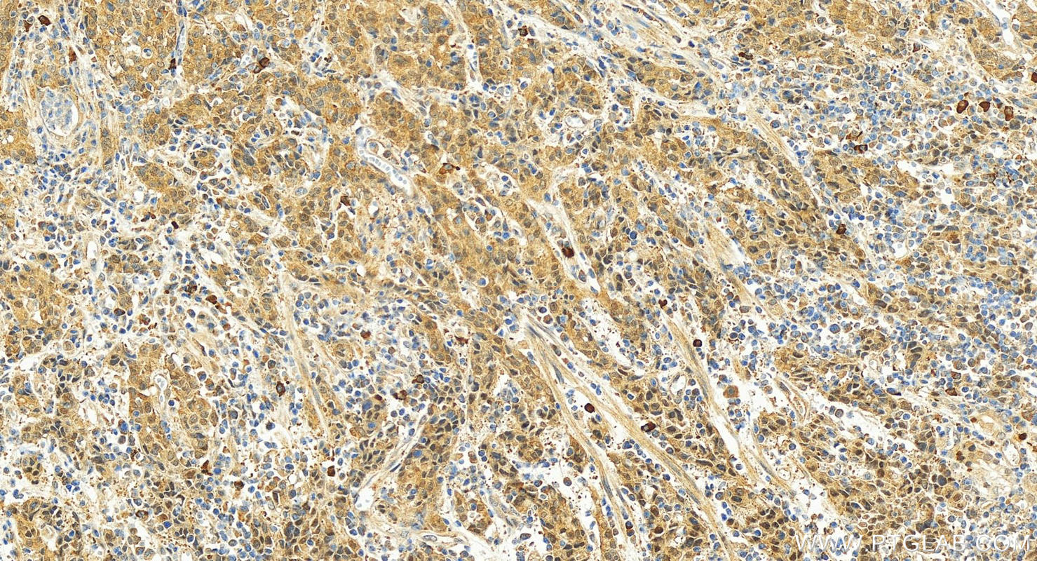 IHC staining of human stomach cancer using 25562-1-AP