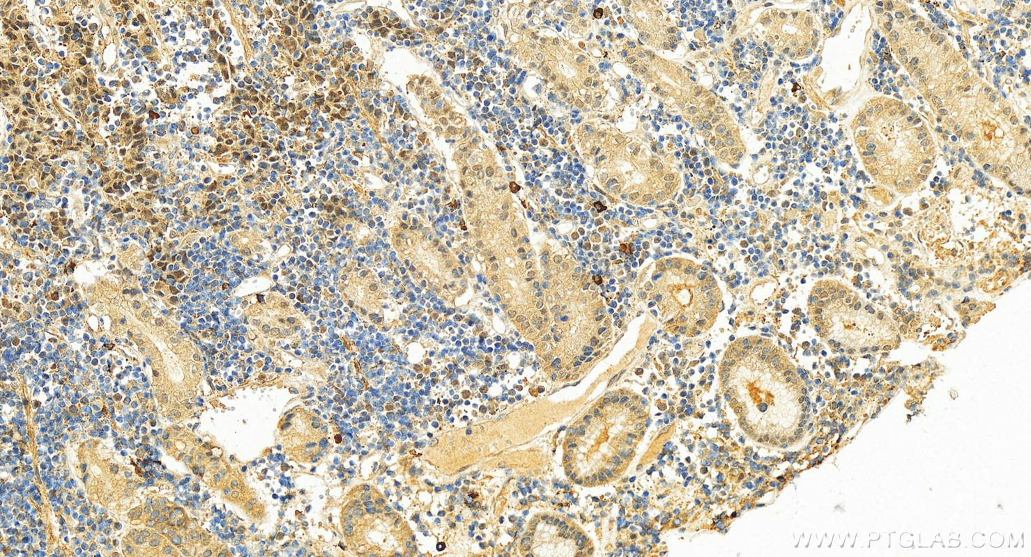 IHC staining of human stomach cancer using 25562-1-AP