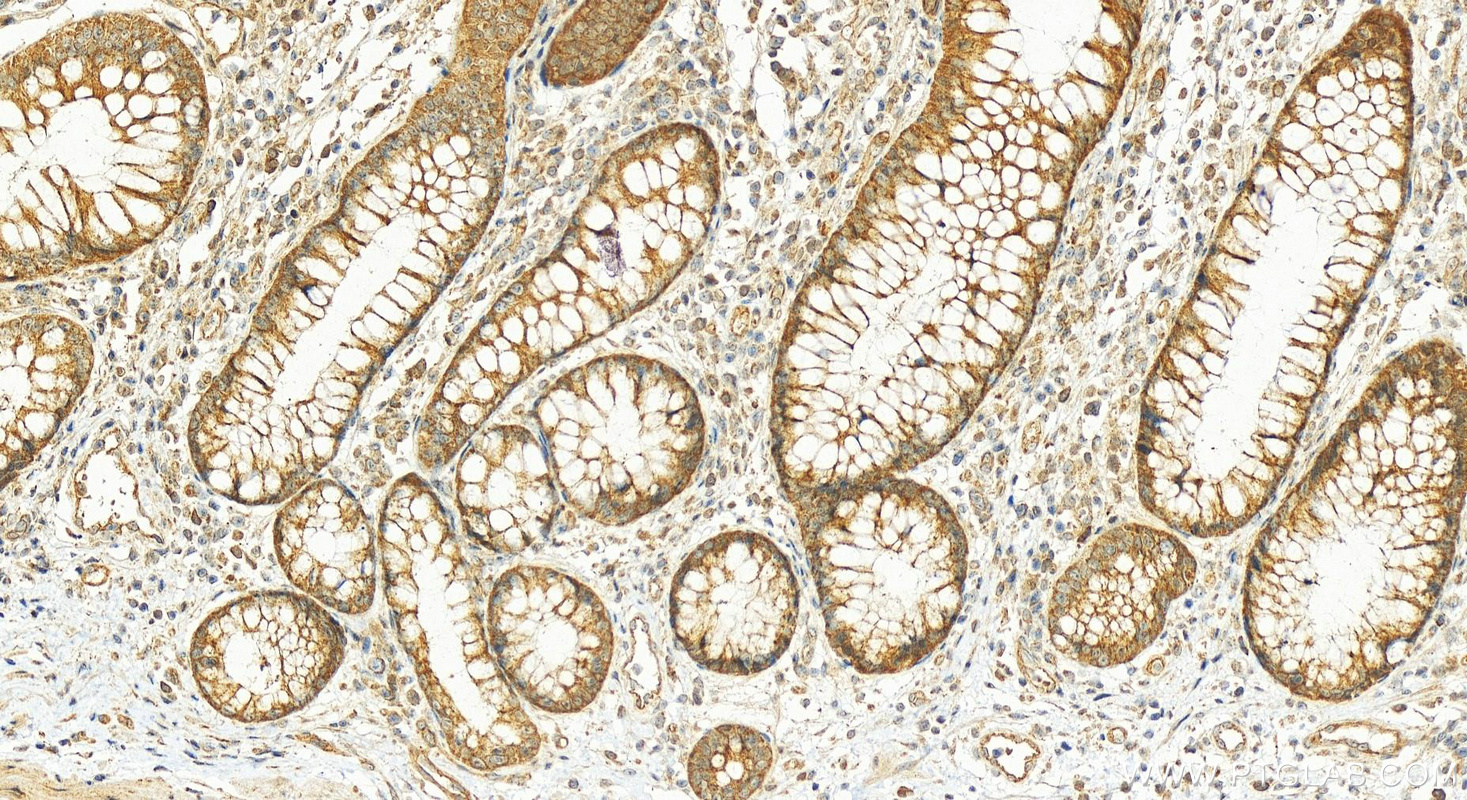 IHC staining of human colon cancer using 17155-1-AP