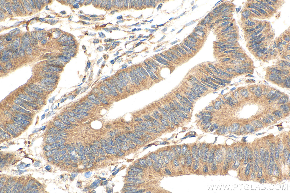 IHC staining of human colon cancer using 67029-1-Ig (same clone as 67029-1-PBS)