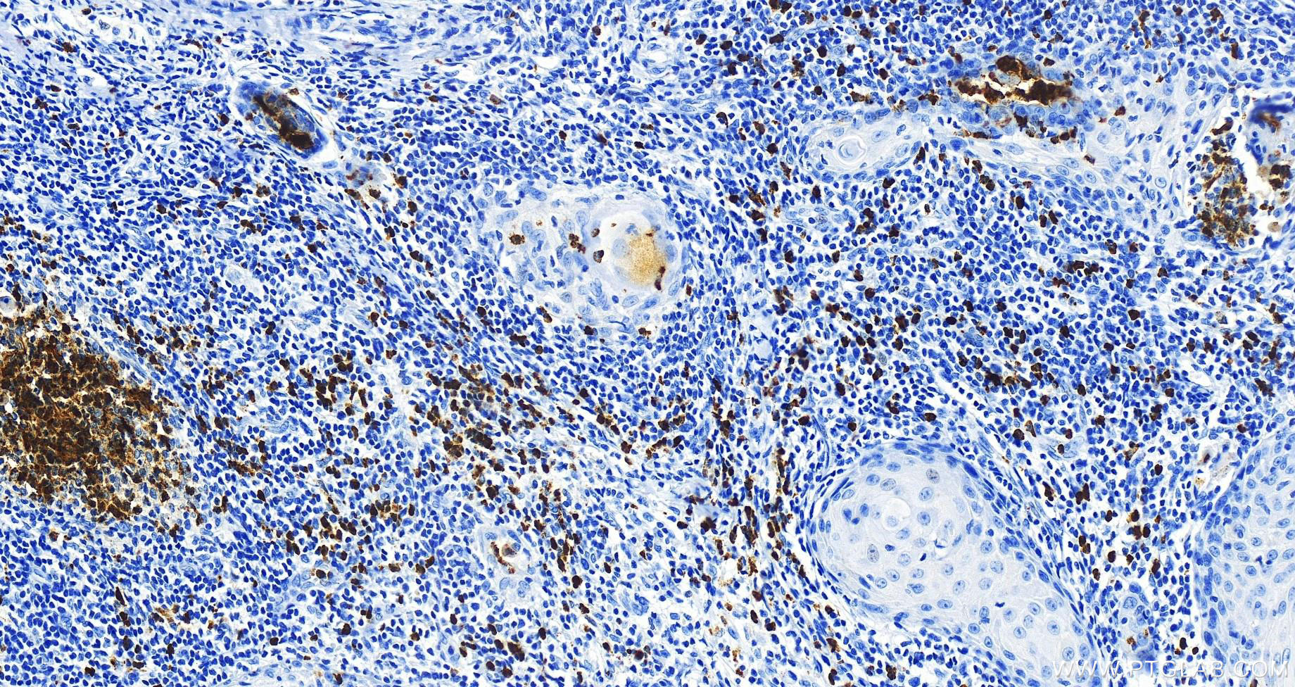 IHC staining of human skin cancer using 68509-1-Ig