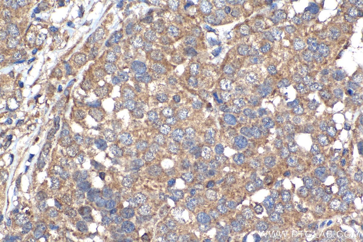 IHC staining of human ovary tumor using 17483-1-AP