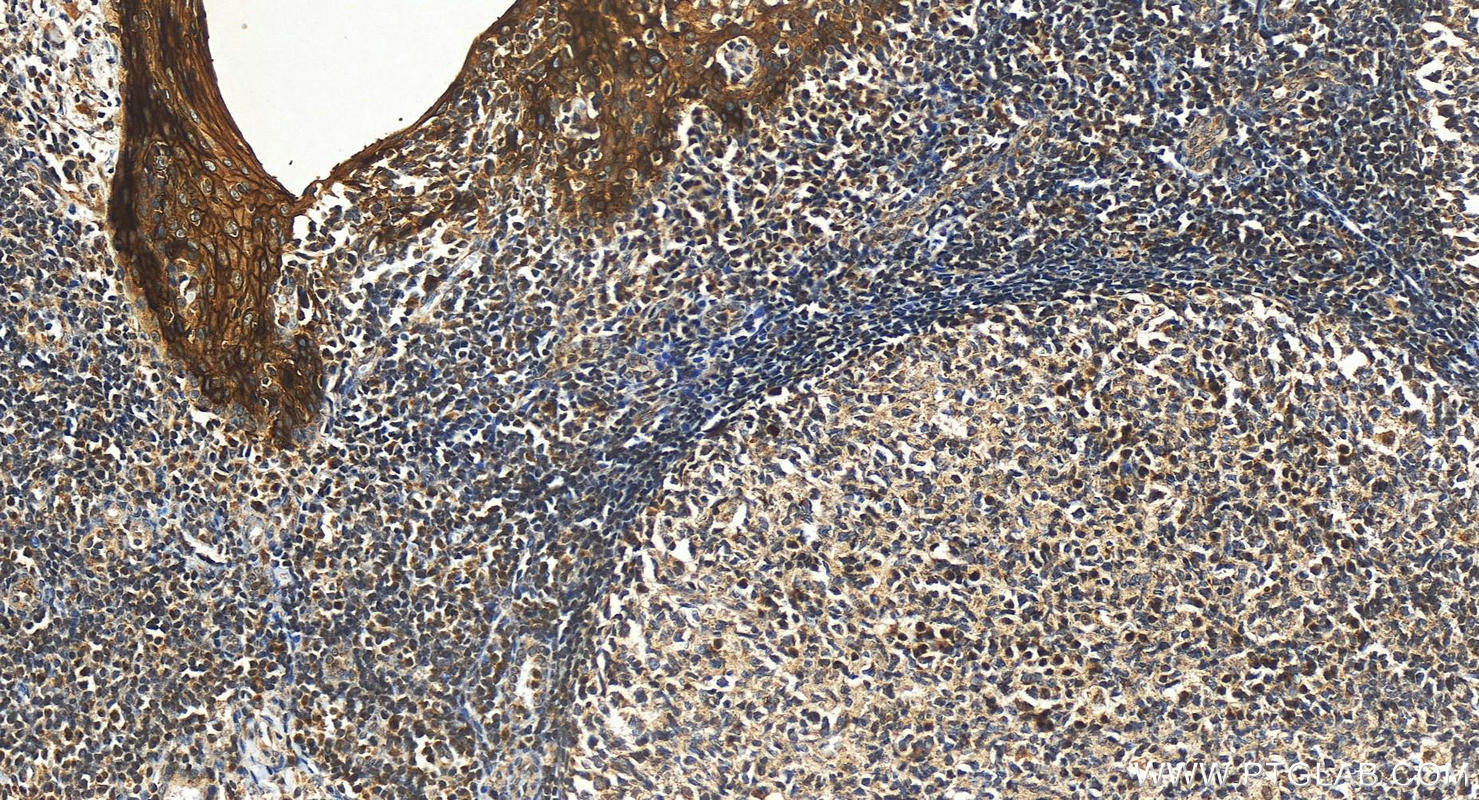 IHC staining of human tonsillitis using 17361-1-AP