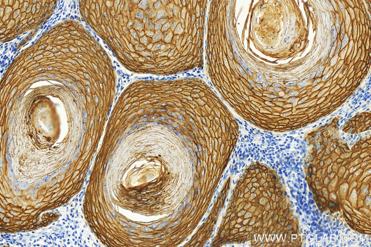 IHC staining of human skin cancer using 82094-1-RR (same clone as 82094-1-PBS)