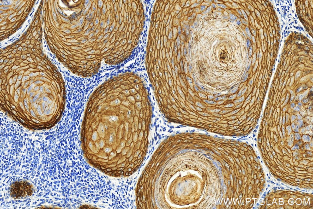 IHC staining of human skin cancer using 82094-1-RR (same clone as 82094-1-PBS)