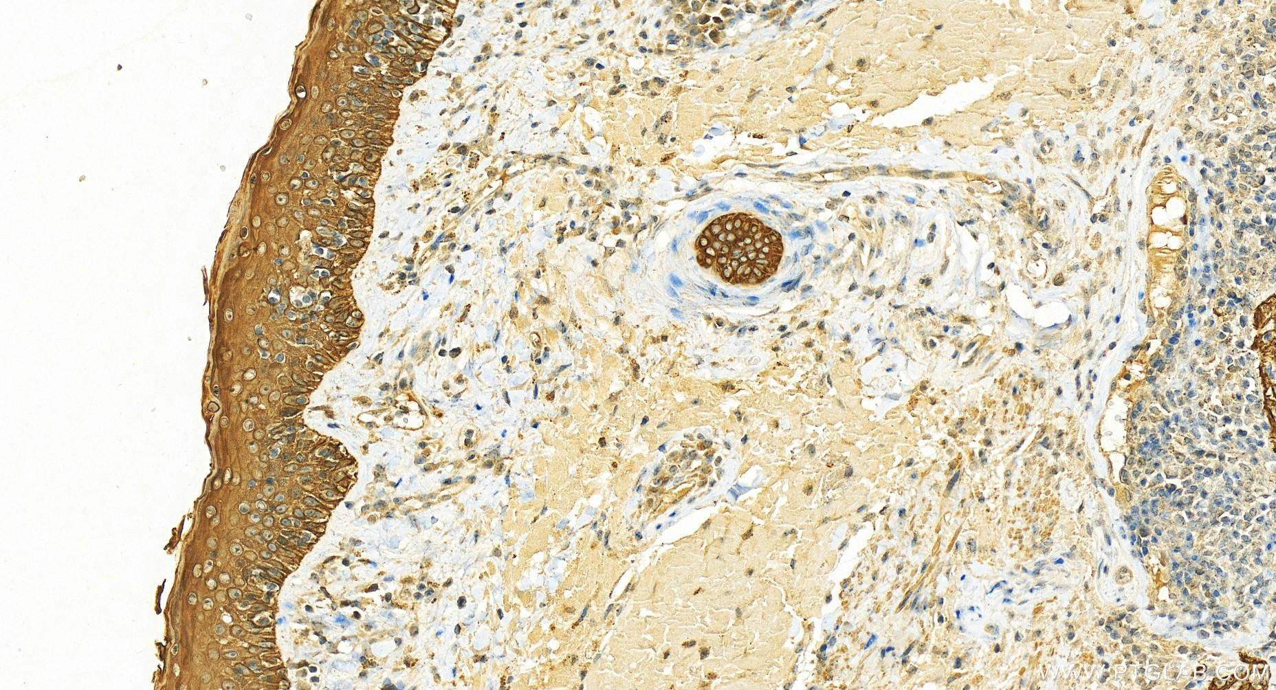 IHC staining of human skin cancer using 12026-1-AP