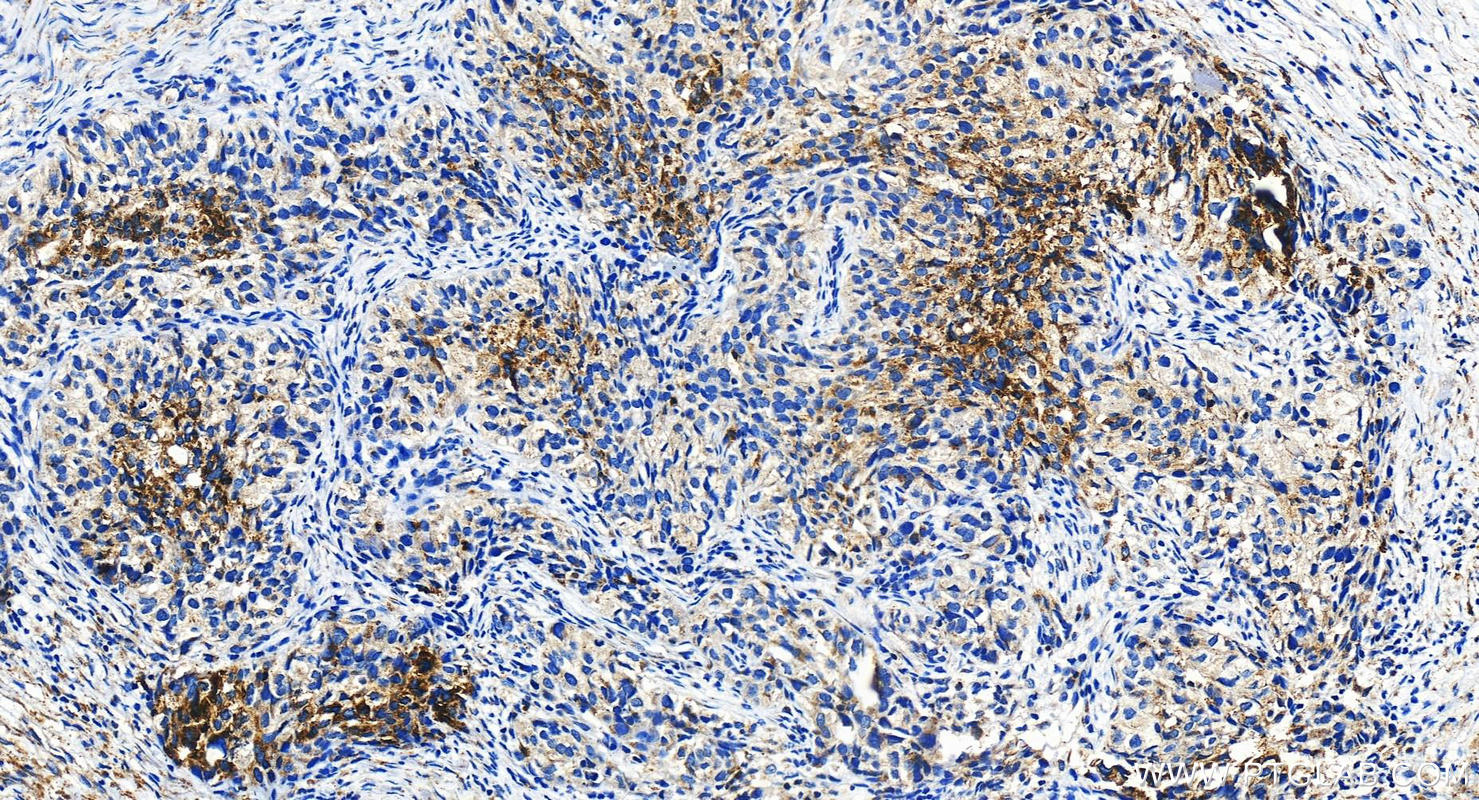 IHC staining of human ovary cancer using 11415-1-AP