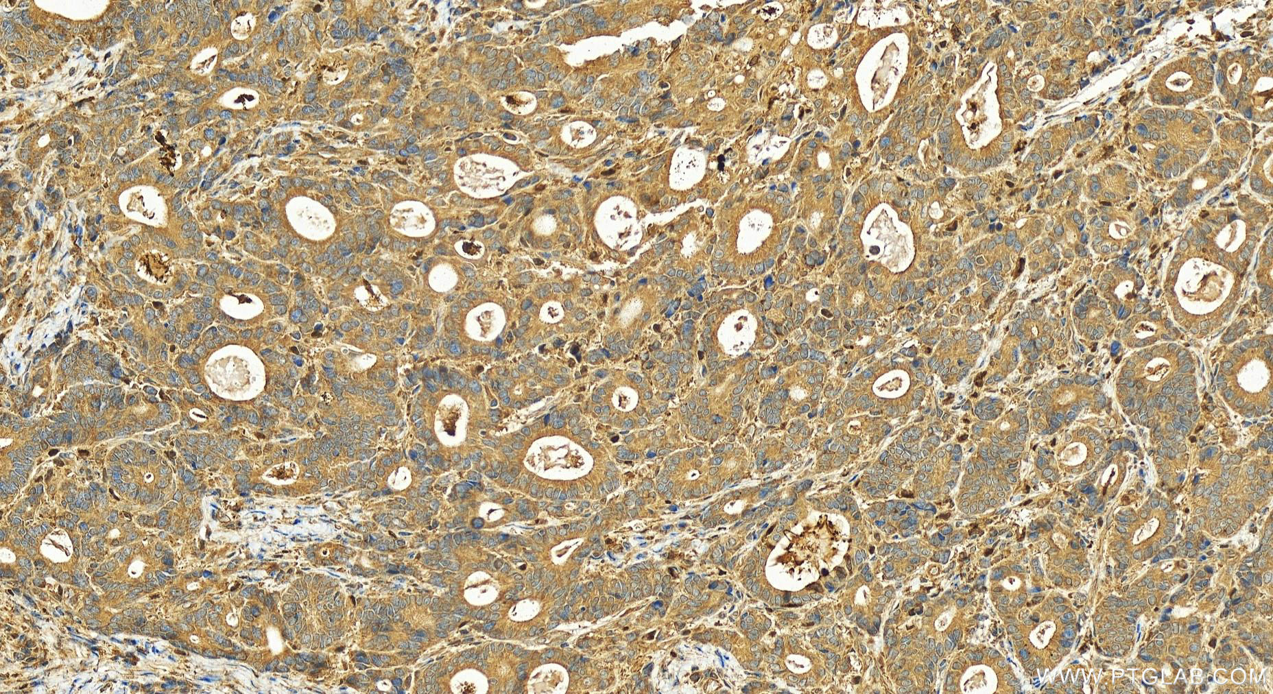 IHC staining of human stomach cancer using 15013-1-AP