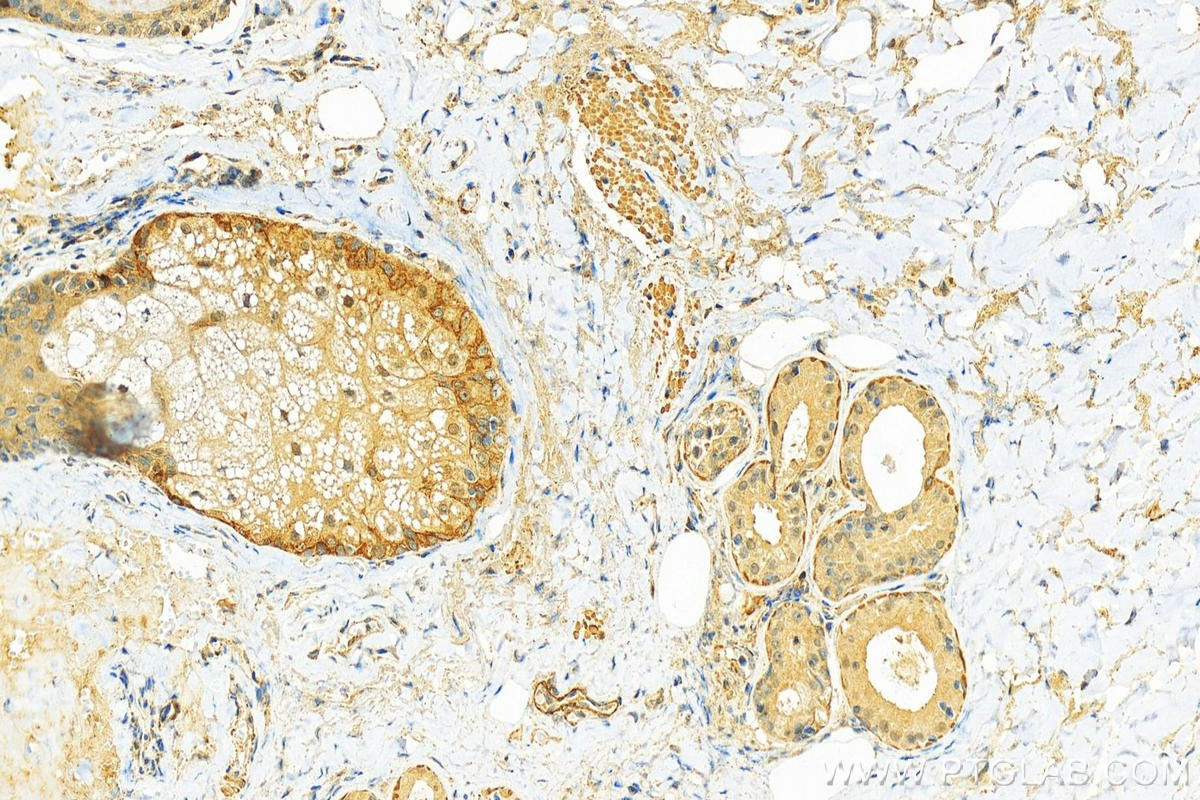 IHC staining of human skin cancer using 20878-1-AP