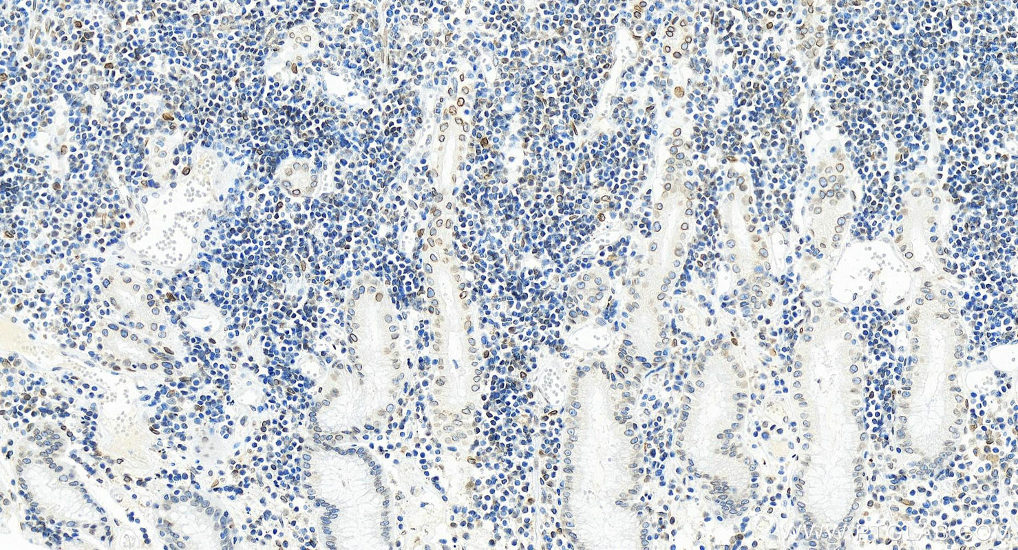 IHC staining of human stomach cancer using 82801-2-RR