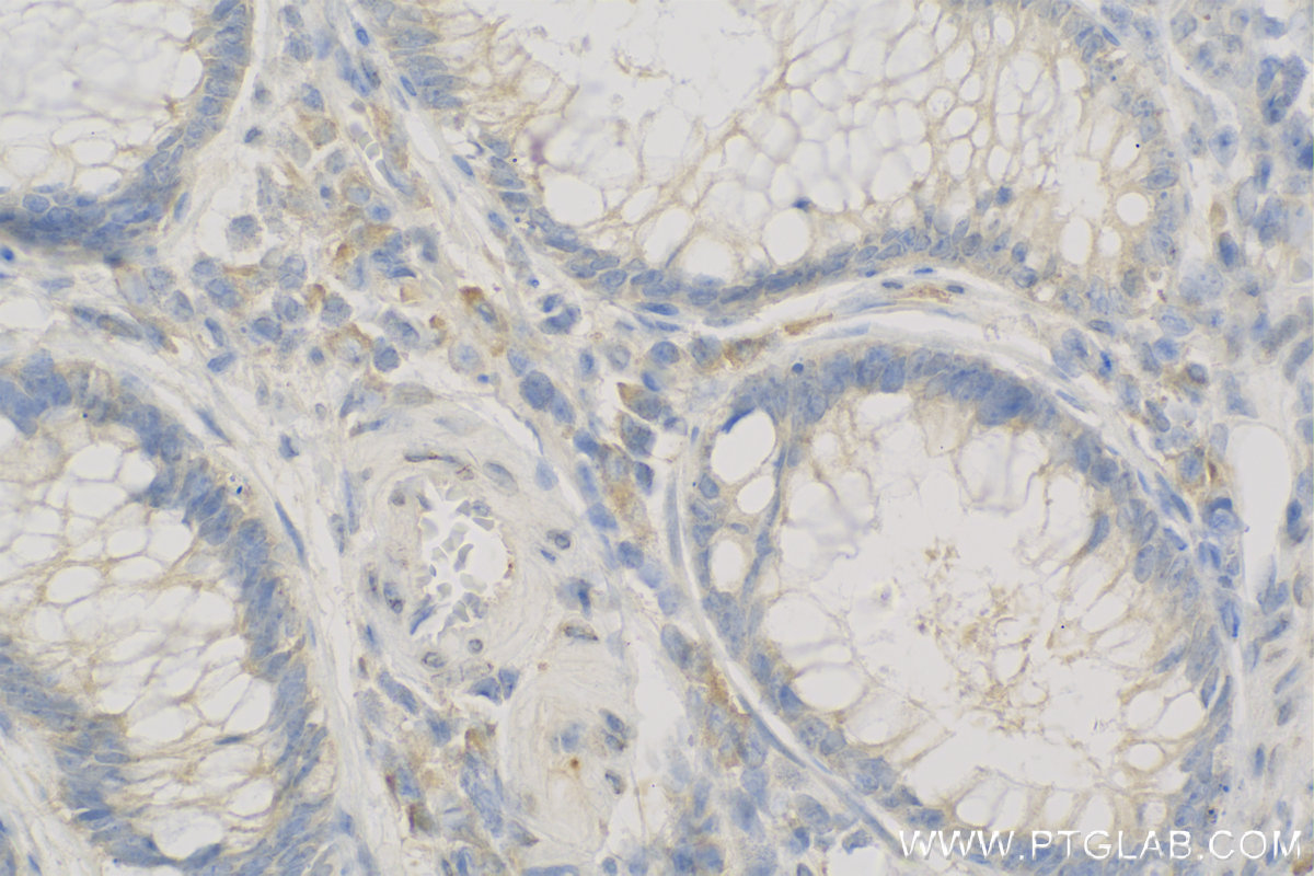 IHC staining of Human Colon cancer using 10971-1-AP