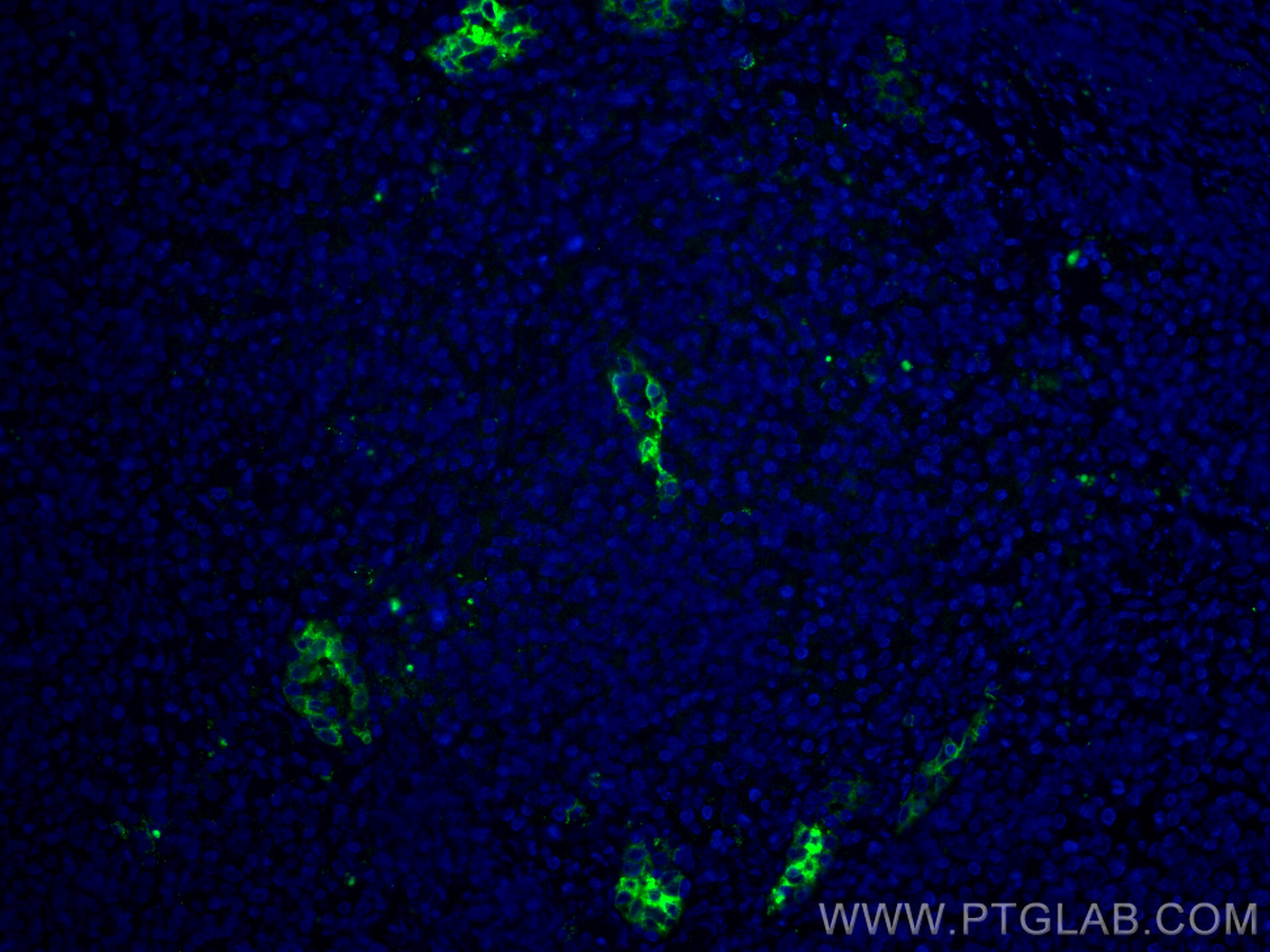 IF Staining of human tonsillitis using 66594-1-Ig