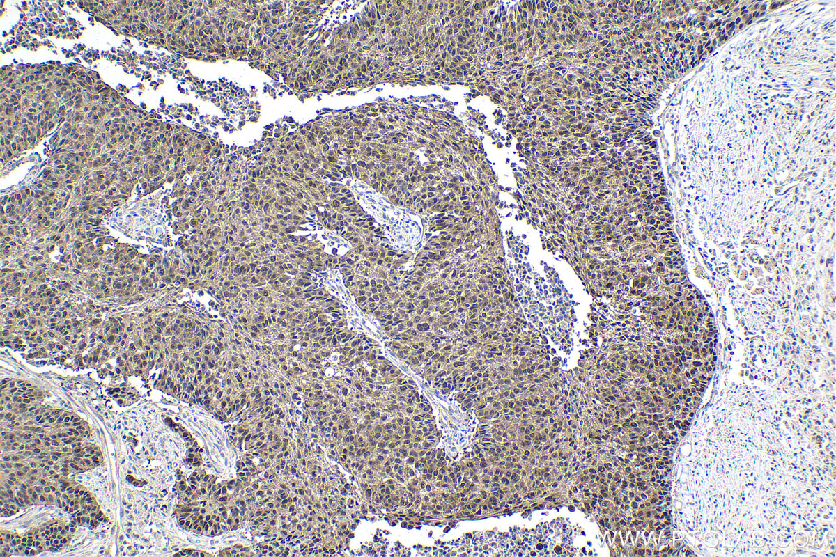 IHC staining of human lung cancer using 12508-1-AP