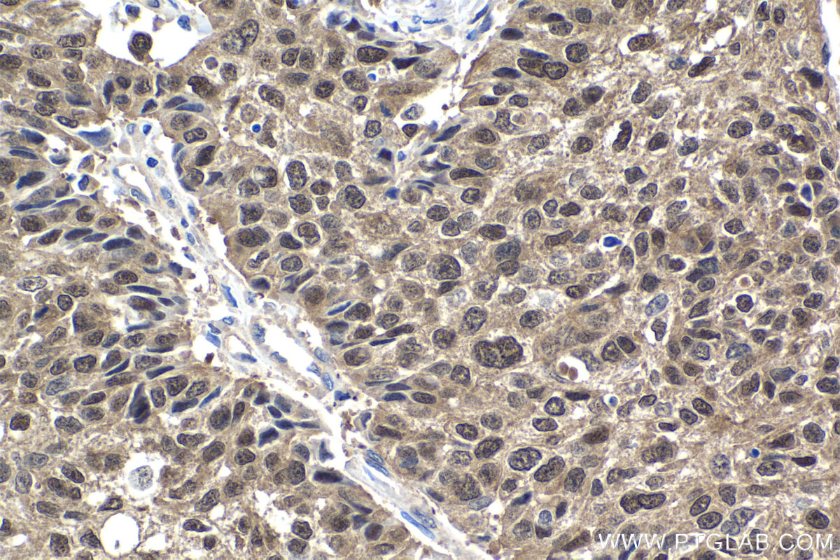 IHC staining of human lung cancer using 12508-1-AP