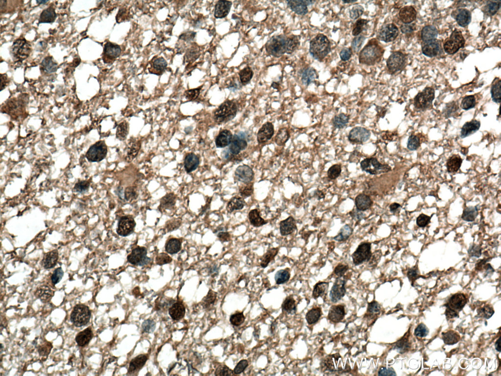 IHC staining of human gliomas using 16809-1-AP