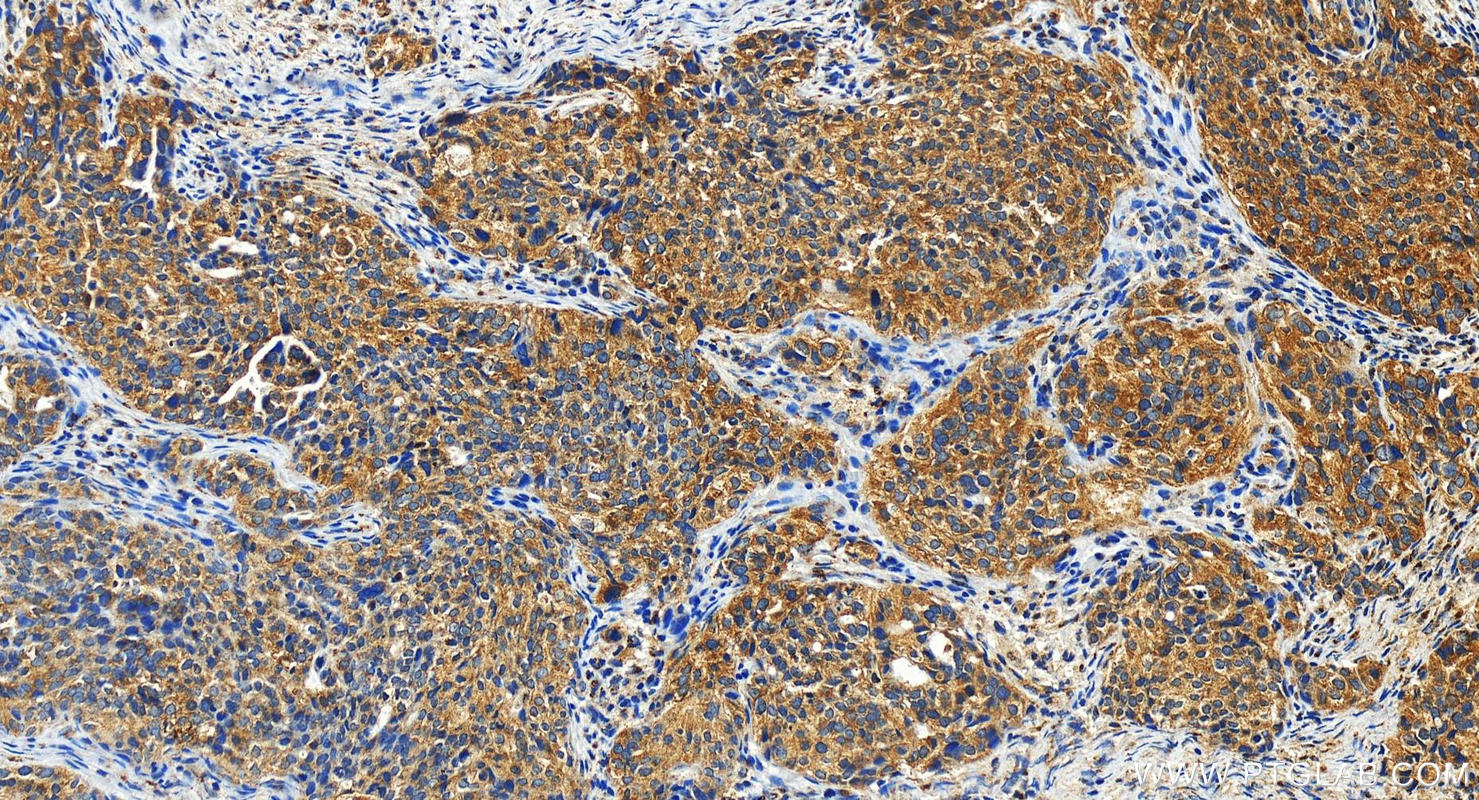 IHC staining of human ovary cancer using 23382-1-AP