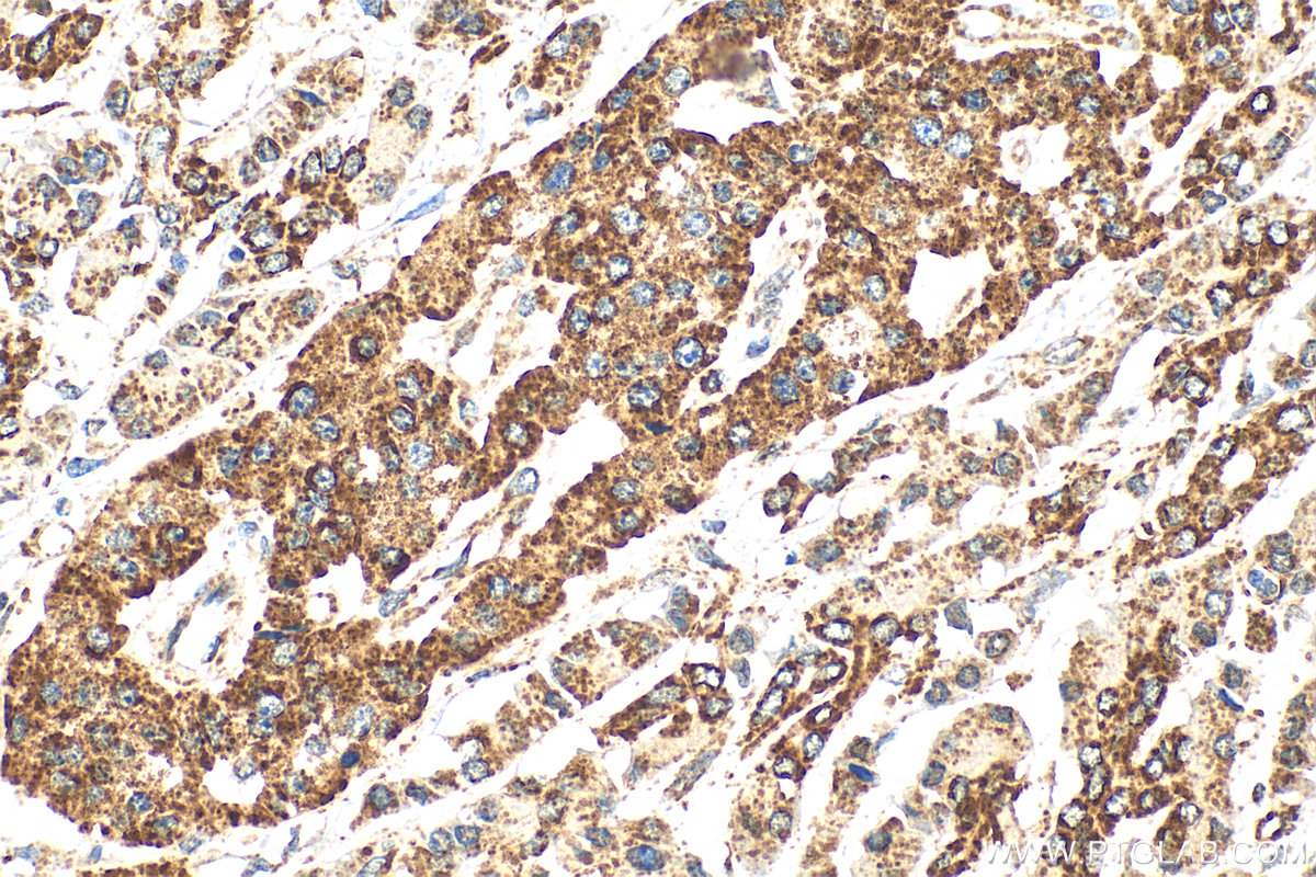 IHC staining of human pancreas cancer using 10539-1-AP